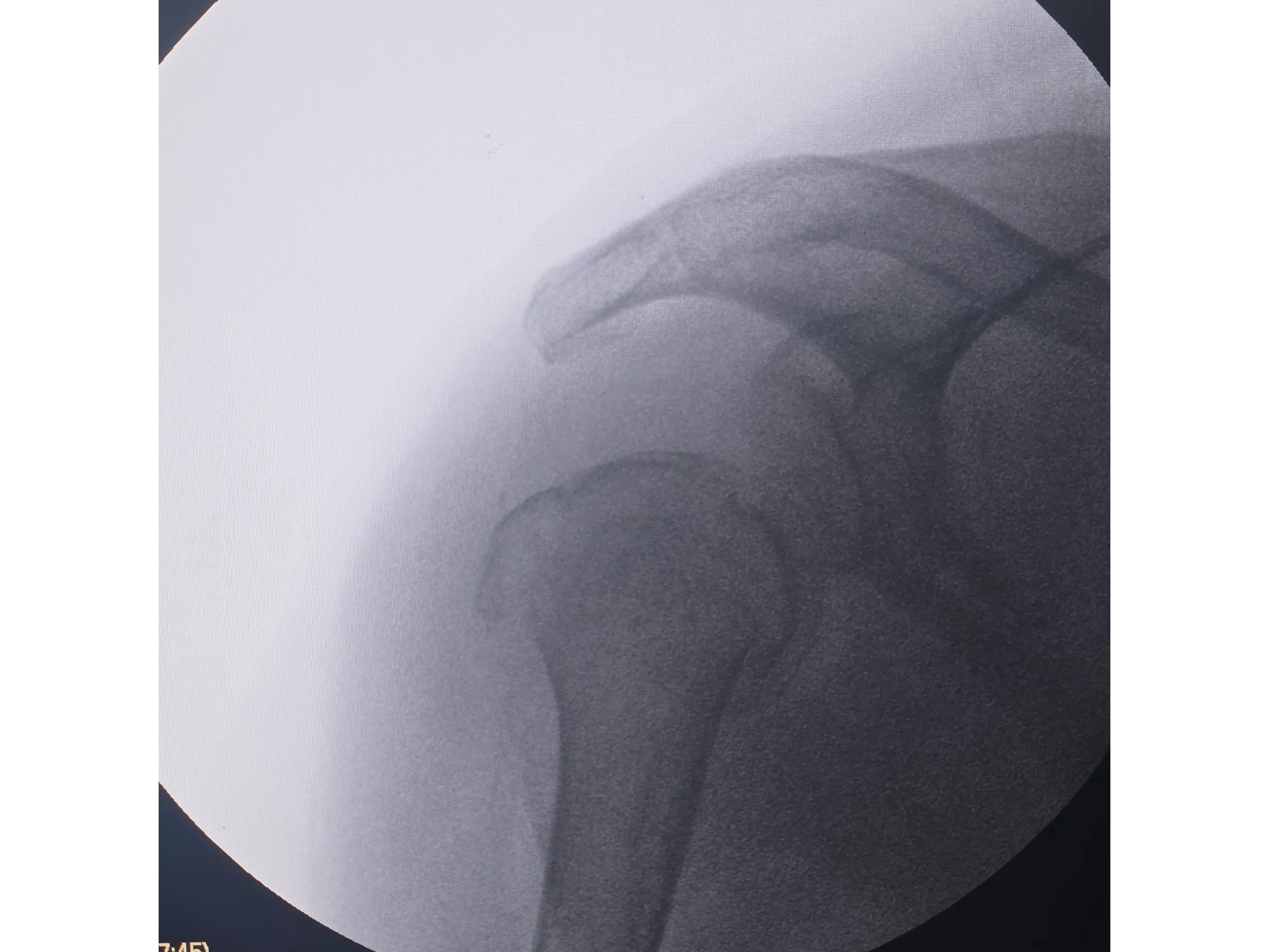 ÚMERO PROXIMAL [Caso 6] · Duas Partes · Placa e Parafusos