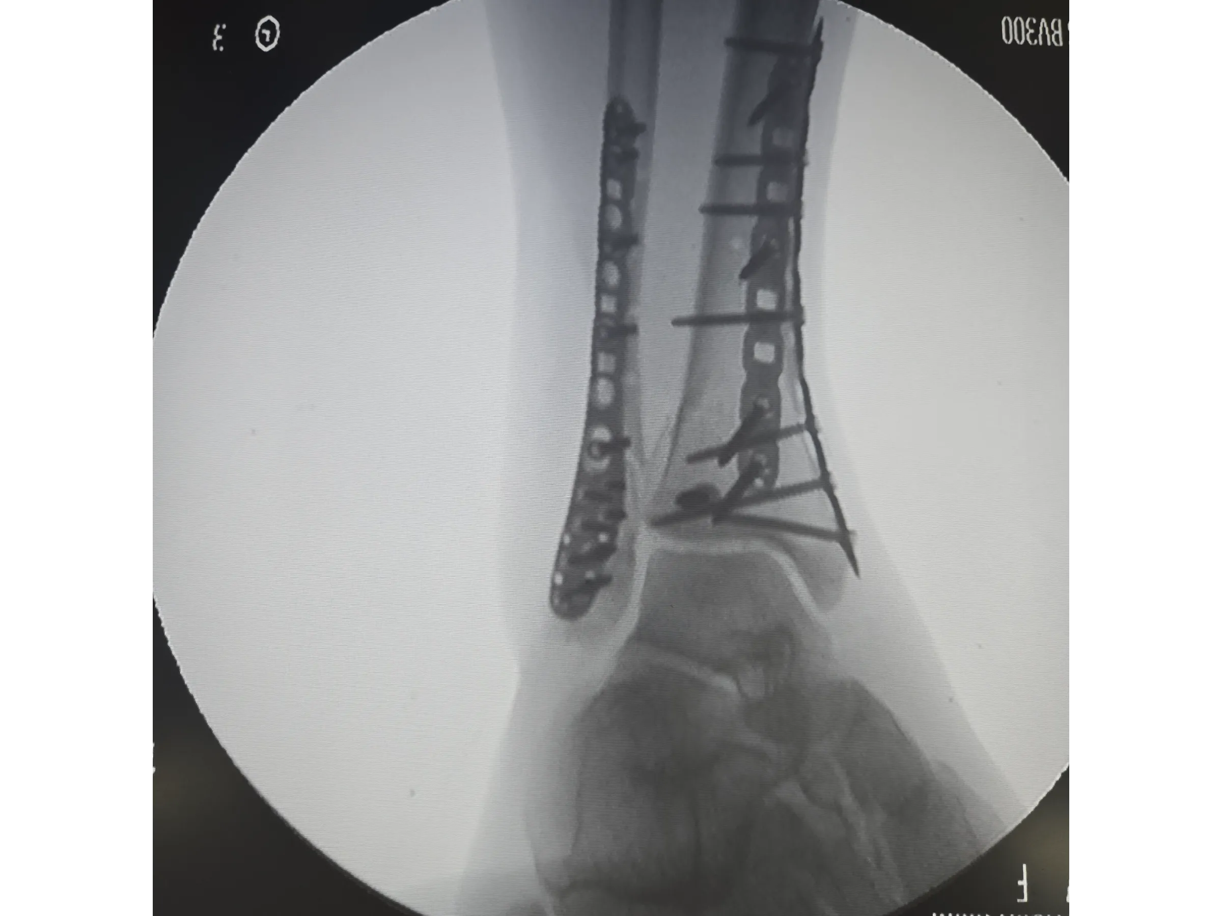 PILÃO TIBIAL [Caso 2] · Abordagem Póstero-Medial + Lateral
