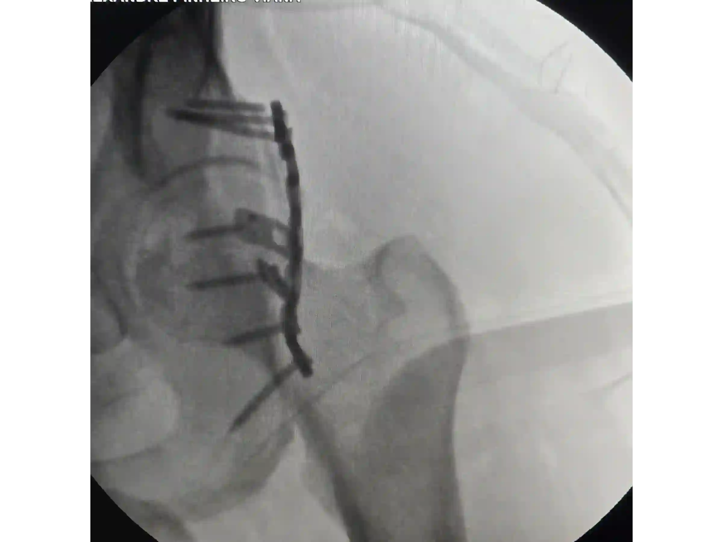 ACETÁBULO [CASO 02] · Rebordo Posterior + Impacção Articular