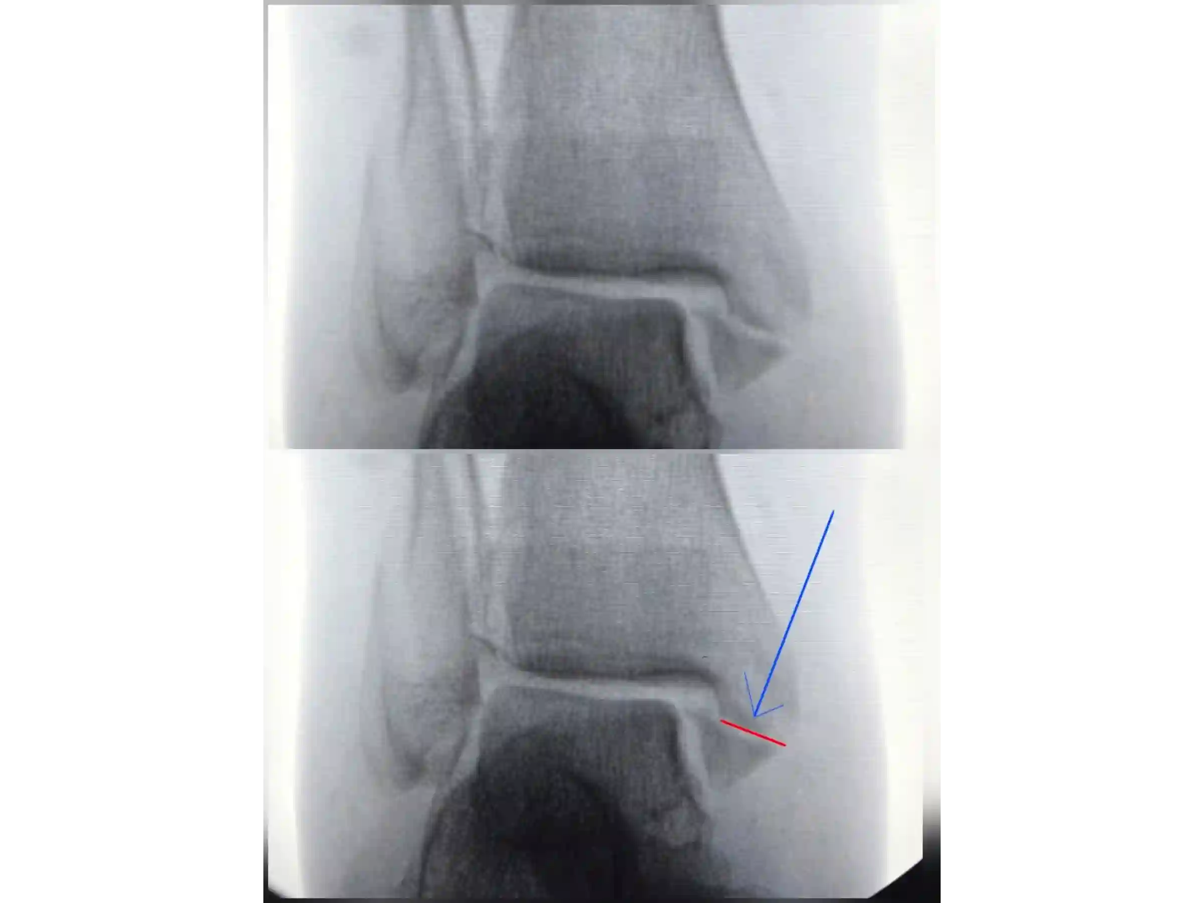 TRIMALEOLAR [CASO 03] Abordagem posterolateral + fixação anterógrada do maléolo medial