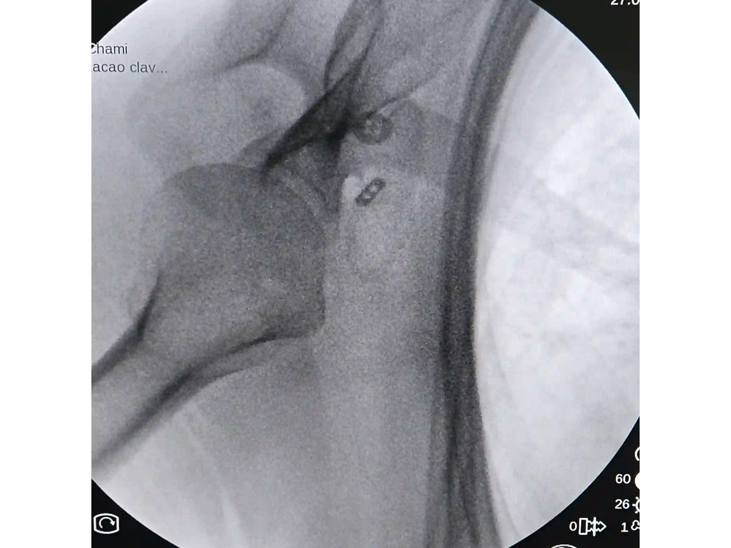 ACROMIOCLAVICULAR [CASO 3] Fixação com TightRope