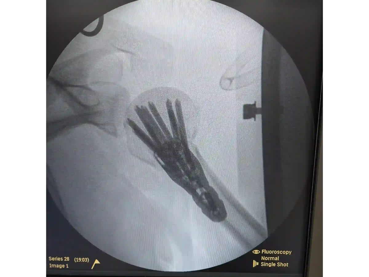 ÚMERO PROXIMAL [CASO 07] - Head-Split Em Paciente Jovem Placa E Parafusos
