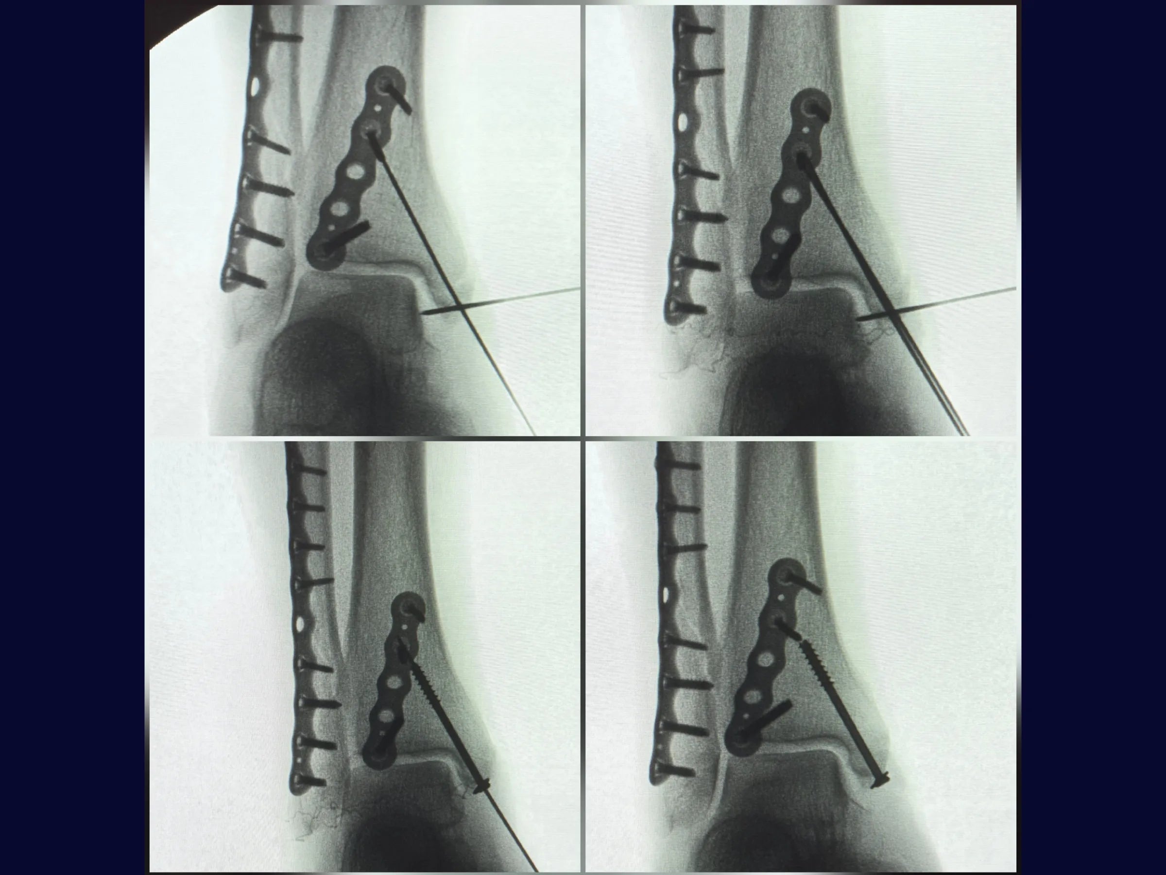 Fratura Trimaleolar - Abordagem em Decúbito Lateral