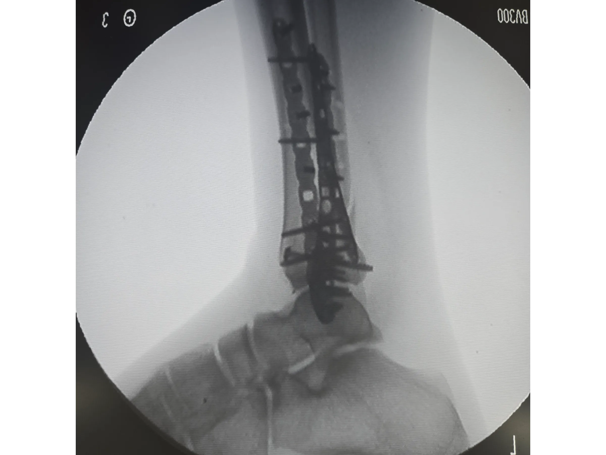 PILÃO TIBIAL [Caso 2] · Abordagem Póstero-Medial + Lateral