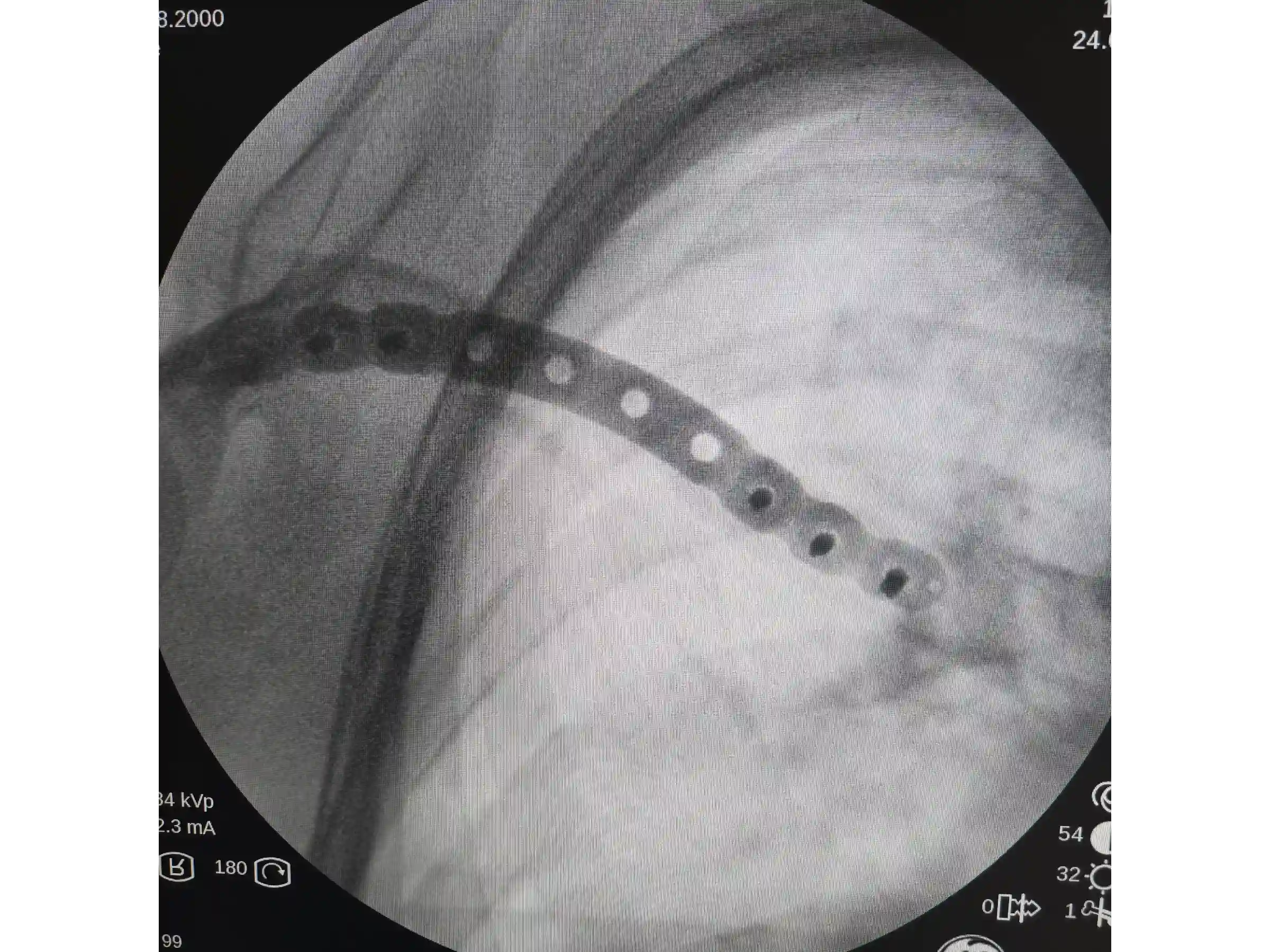 CLAVICLE [CASE 03] - Minimally Invasive Percutaneous Osteosynthesis