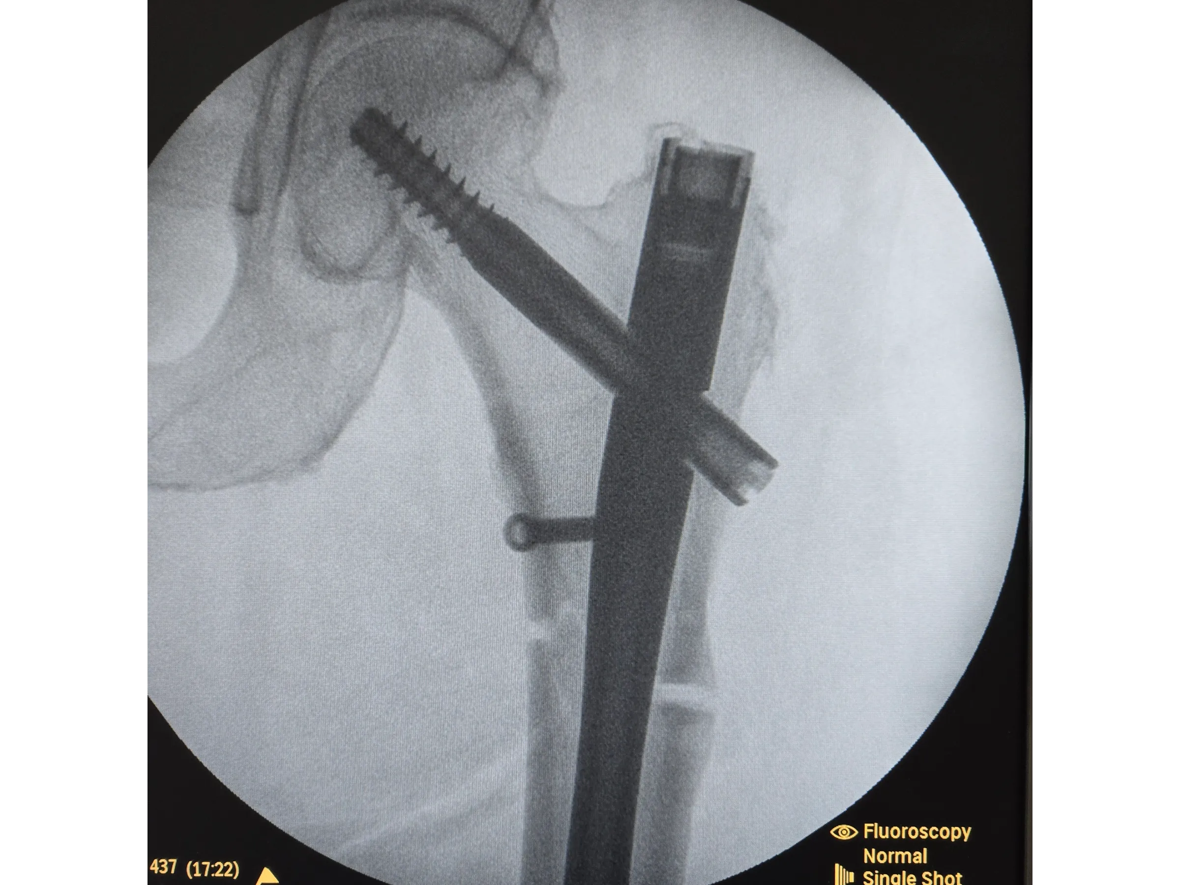 FRATURA SUBTROCANTERIANA [Caso 1] · Haste Intramedular Minimamente Invasiva