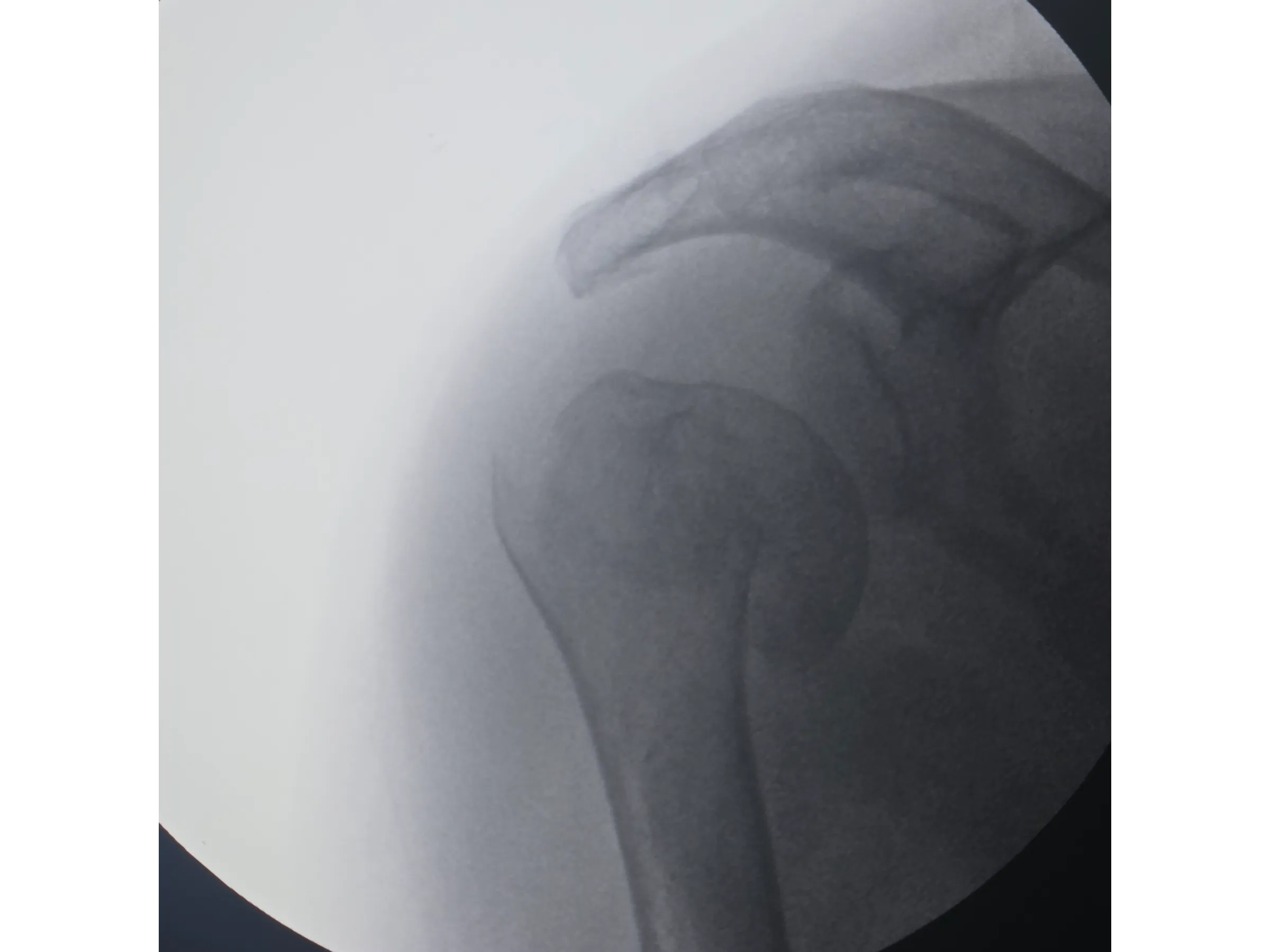 ÚMERO PROXIMAL [Caso 6] · Duas Partes · Placa e Parafusos