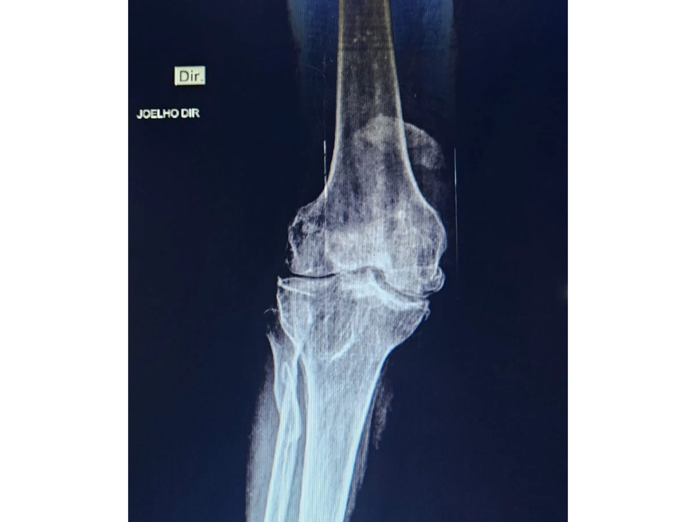 PATELA [Caso 2] · Parafusos Canulados + Cerclagem