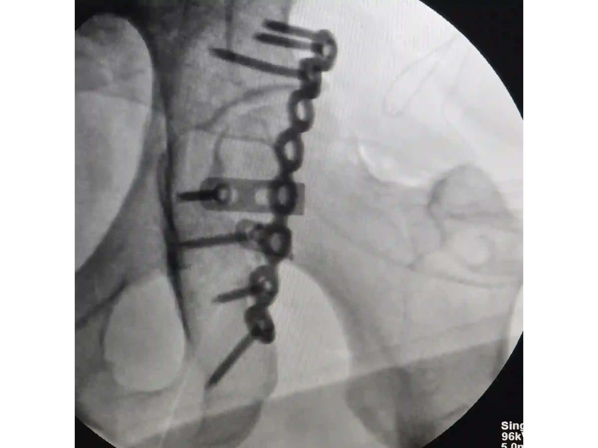 ACETÁBULO [CASO 02] · Rebordo Posterior + Impacção Articular