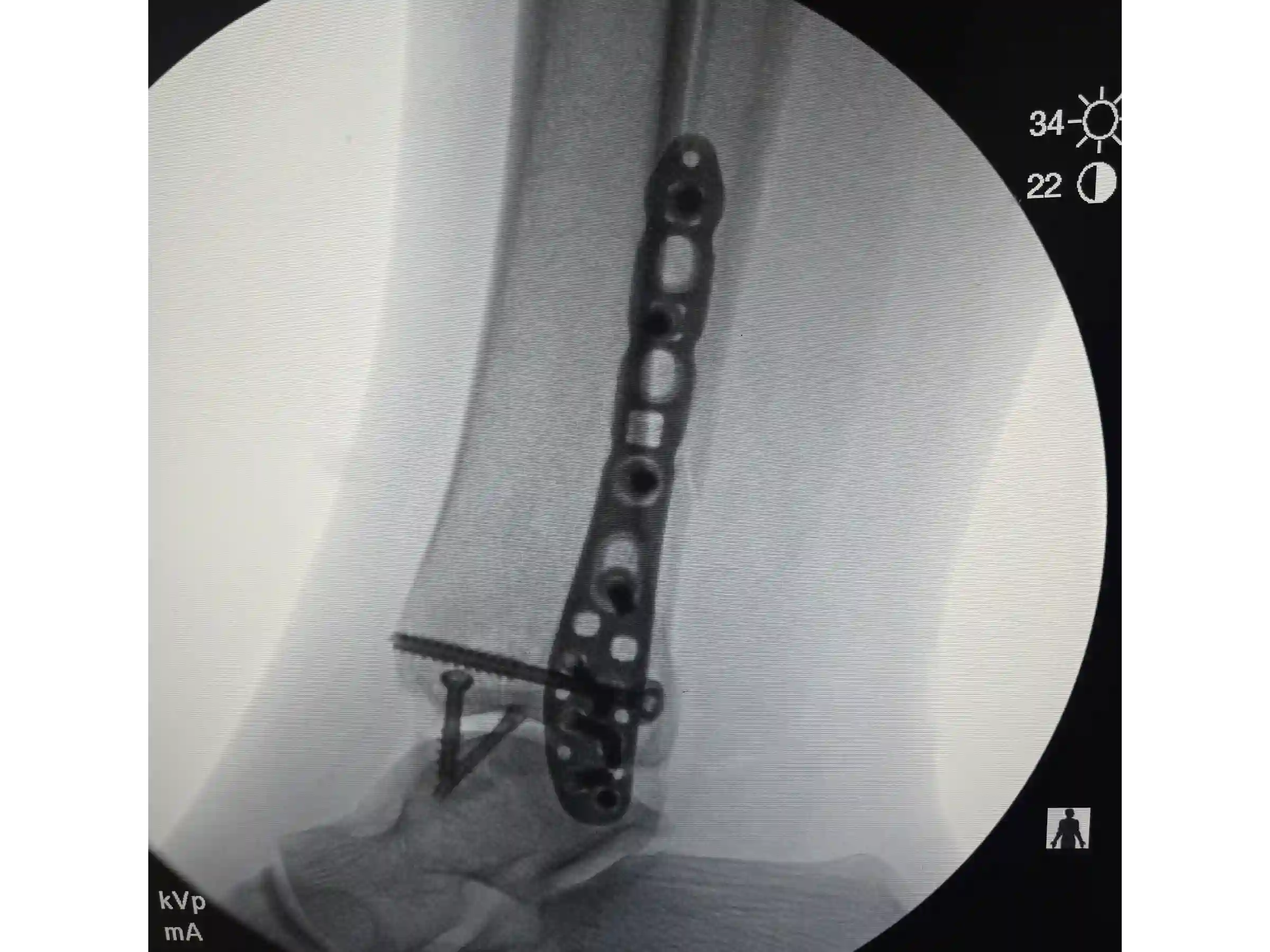 TRIMALEOLAR [CASO 03] Abordagem posterolateral + fixação anterógrada do maléolo medial