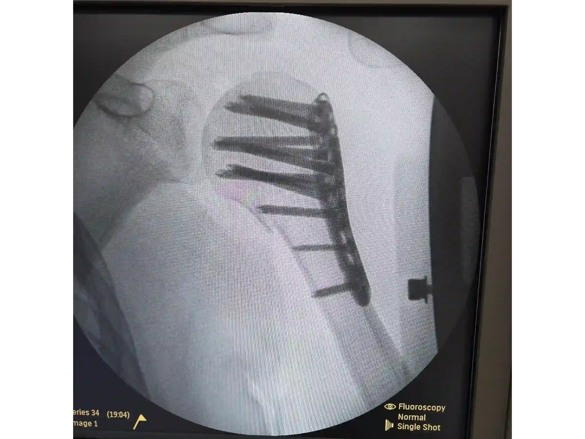 ÚMERO PROXIMAL [CASO 07] - Head-Split Em Paciente Jovem Placa E Parafusos