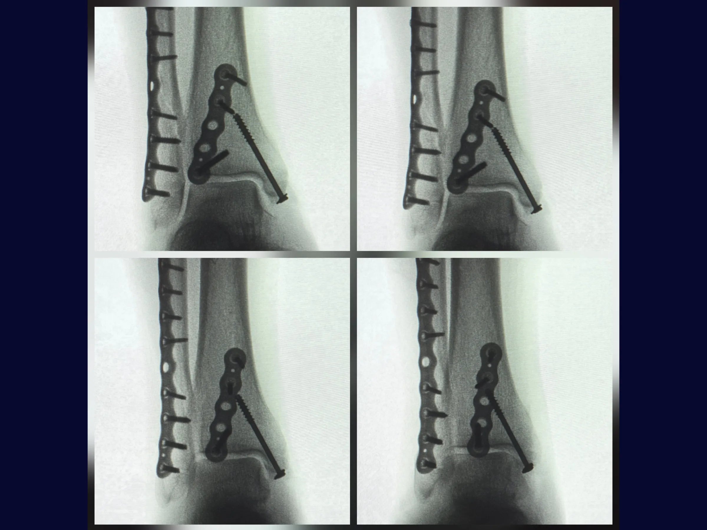 Fratura Trimaleolar - Abordagem em Decúbito Lateral