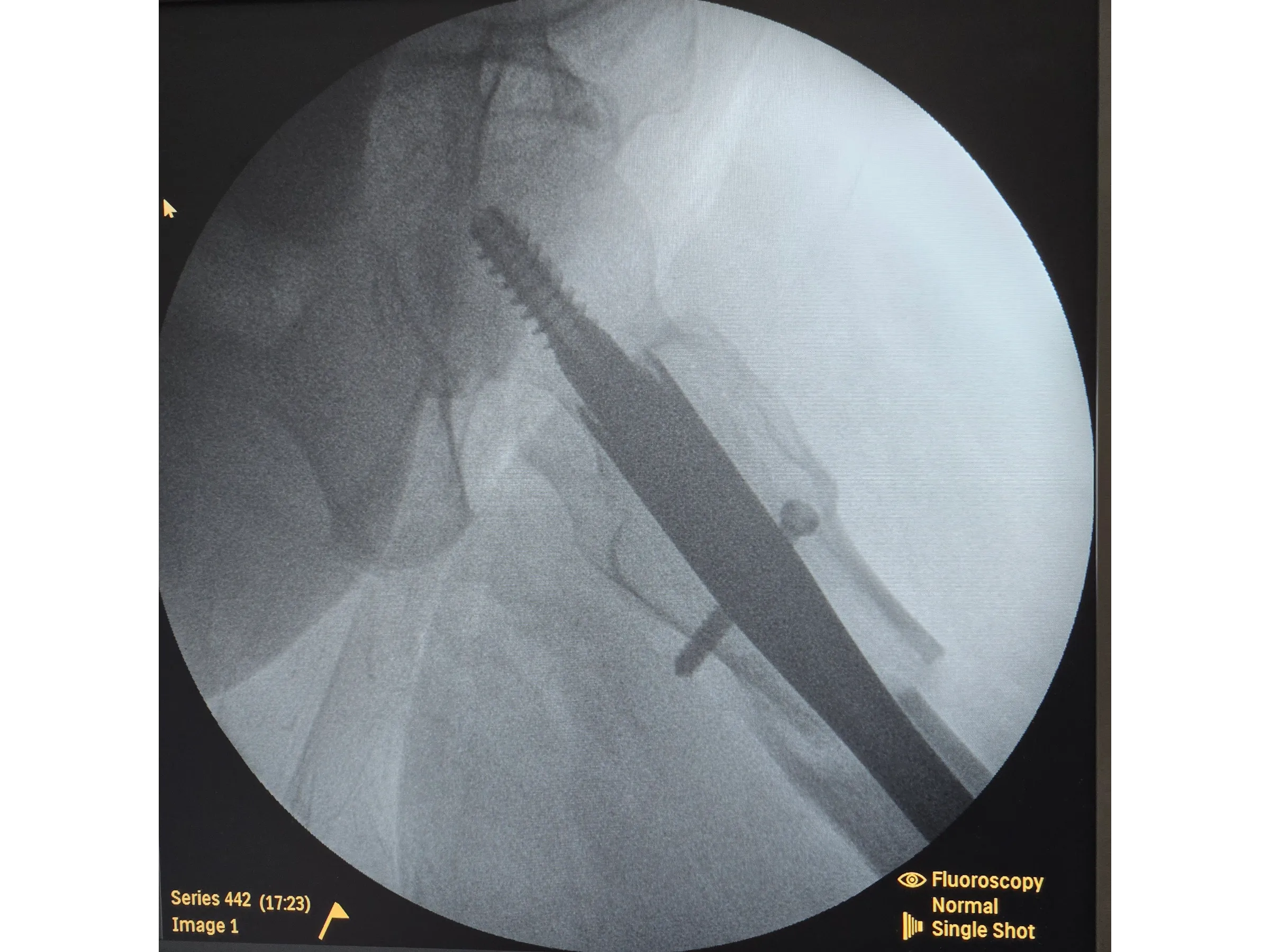 FRATURA SUBTROCANTERIANA [Caso 1] · Haste Intramedular Minimamente Invasiva