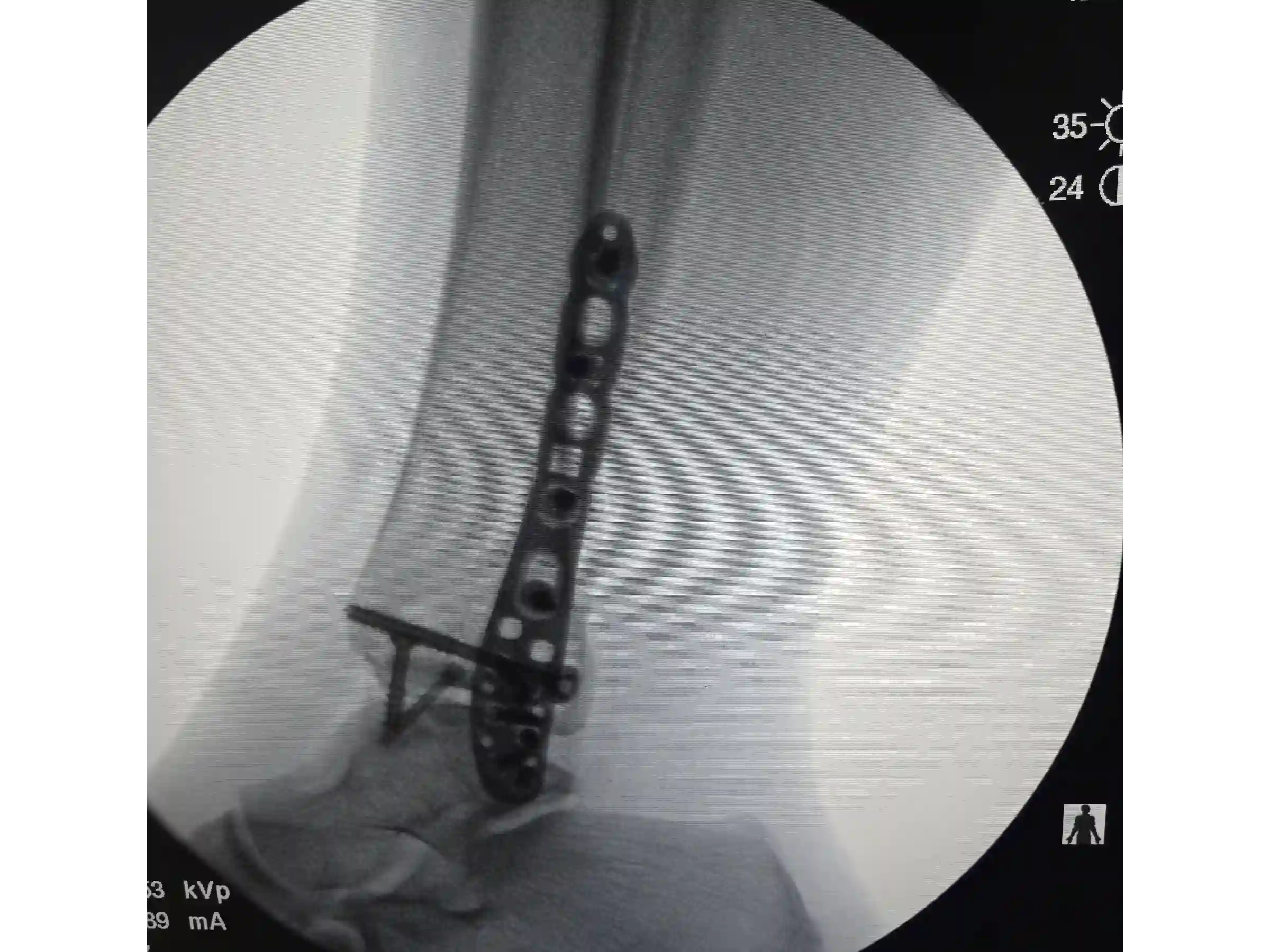 TRIMALEOLAR [CASO 03] Abordagem posterolateral + fixação anterógrada do maléolo medial