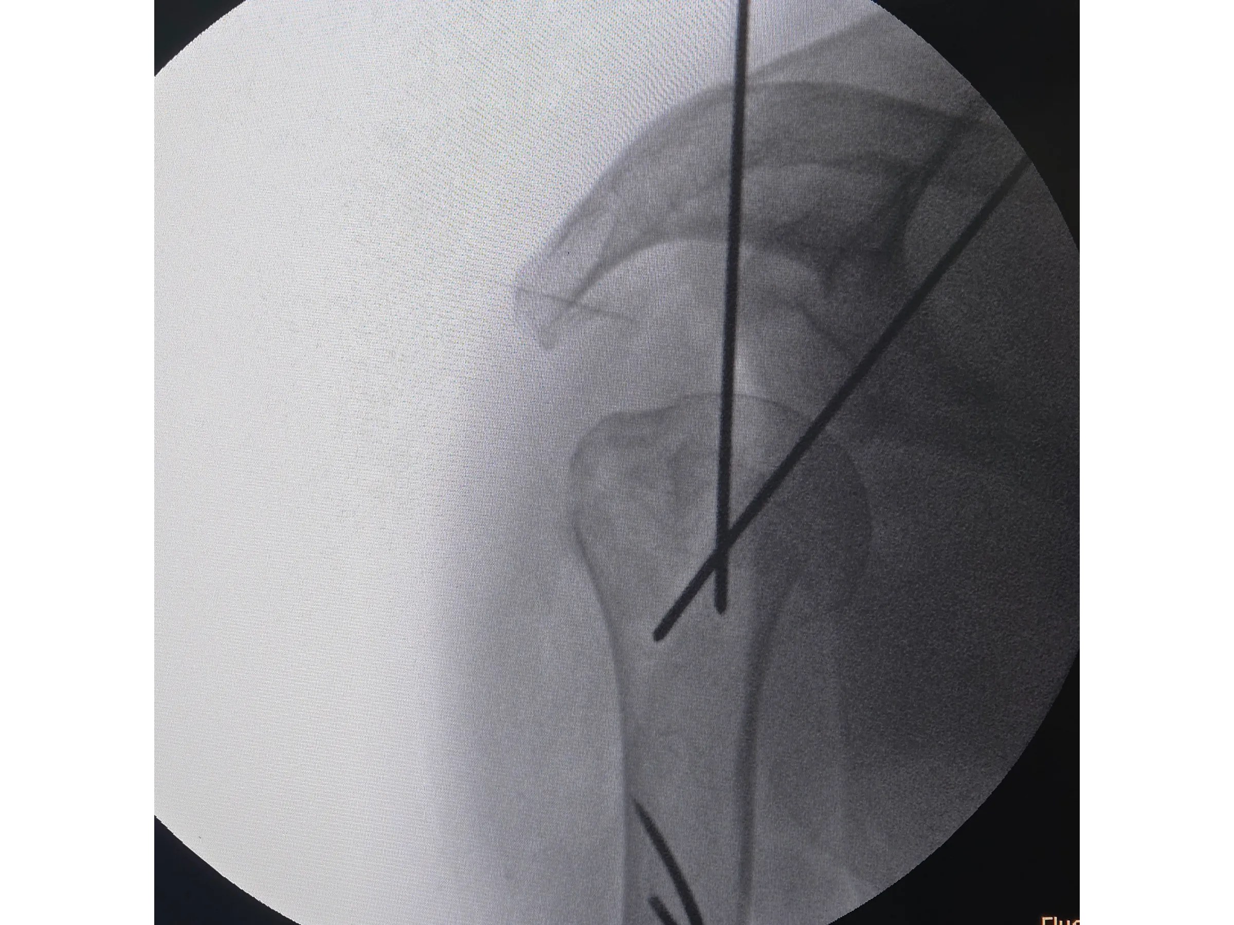 ÚMERO PROXIMAL [Caso 6] · Duas Partes · Placa e Parafusos