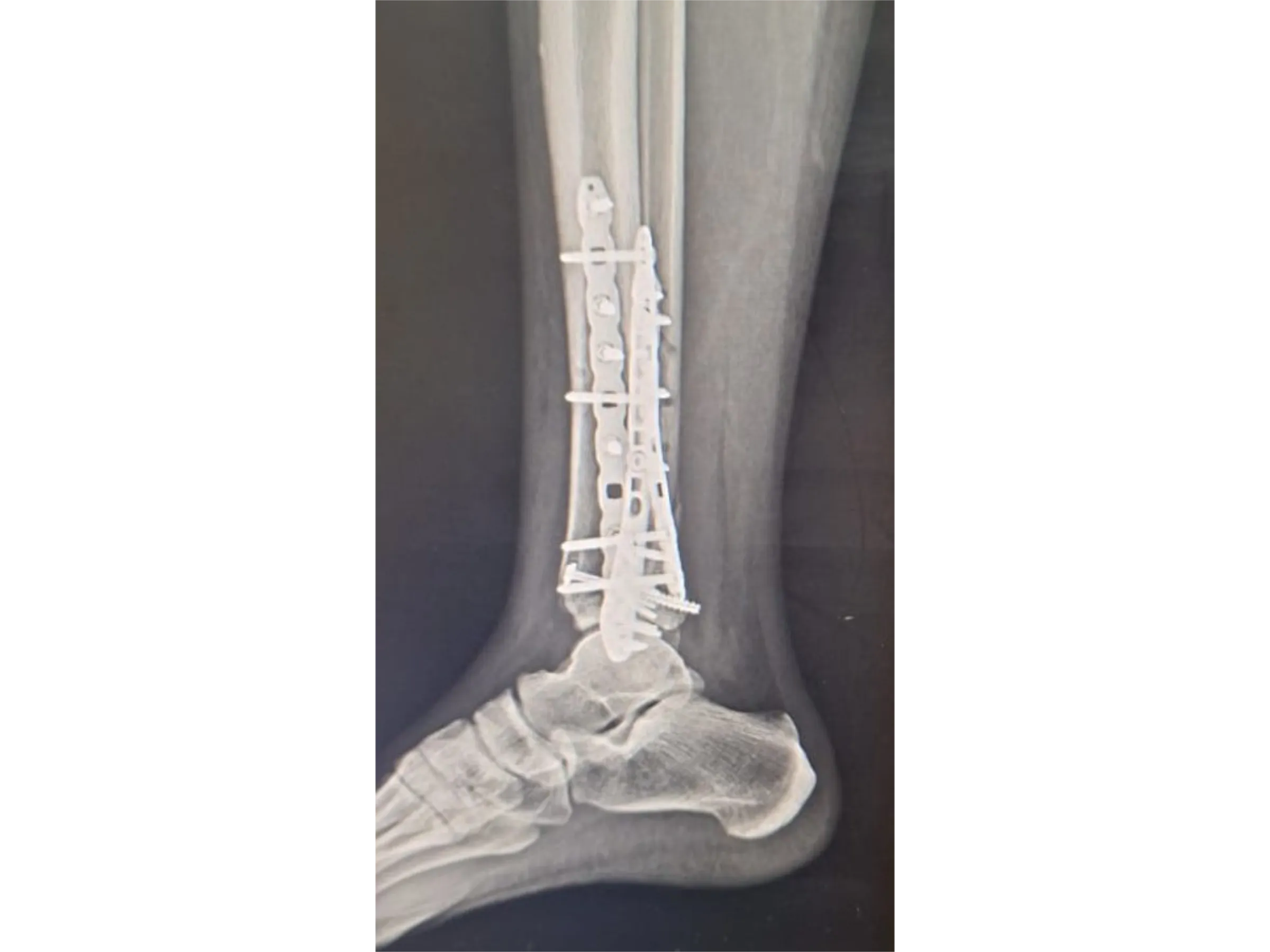 PILÃO TIBIAL [Caso 2] · Abordagem Póstero-Medial + Lateral