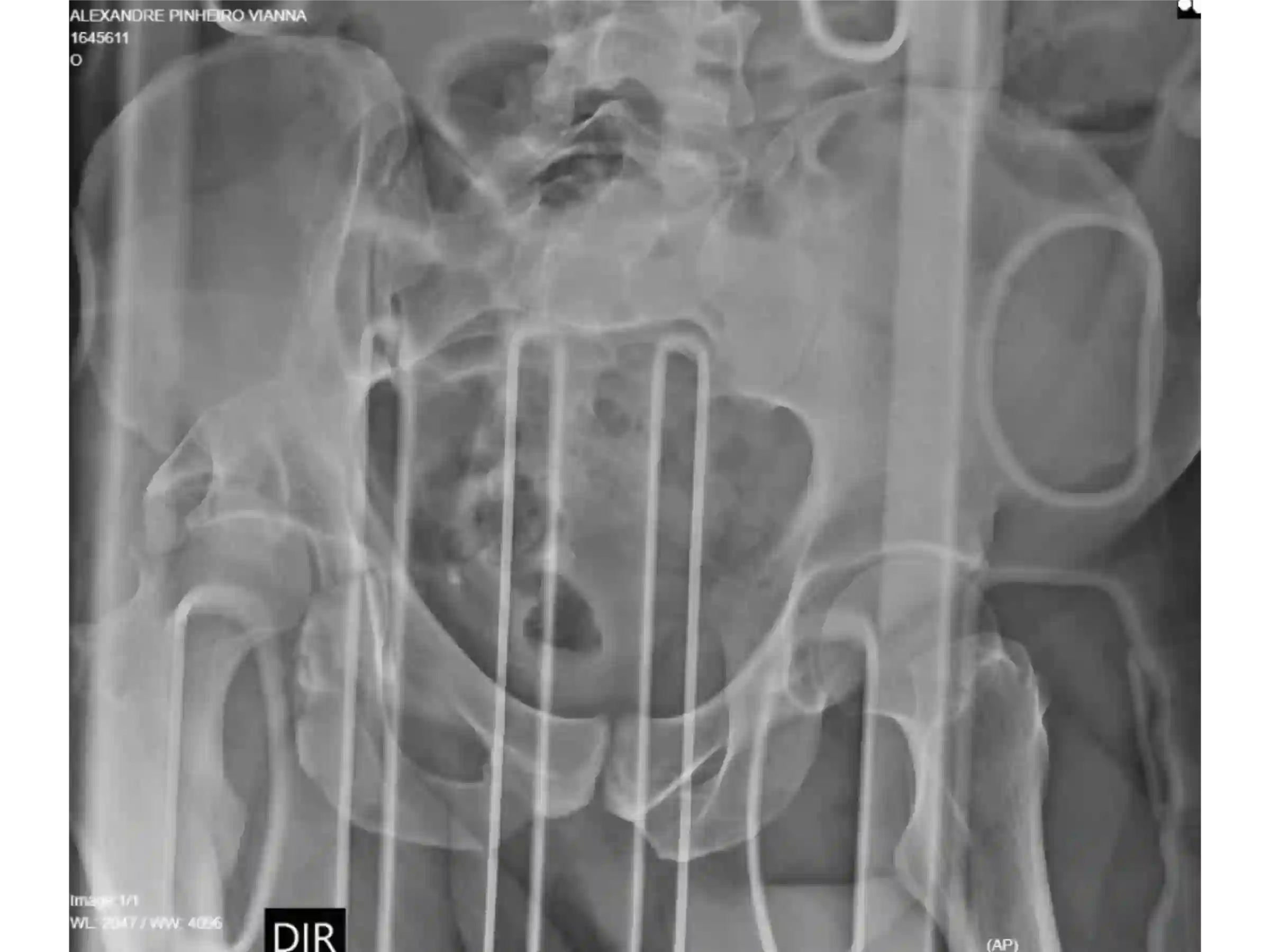 ACETÁBULO [CASO 02] · Rebordo Posterior + Impacção Articular