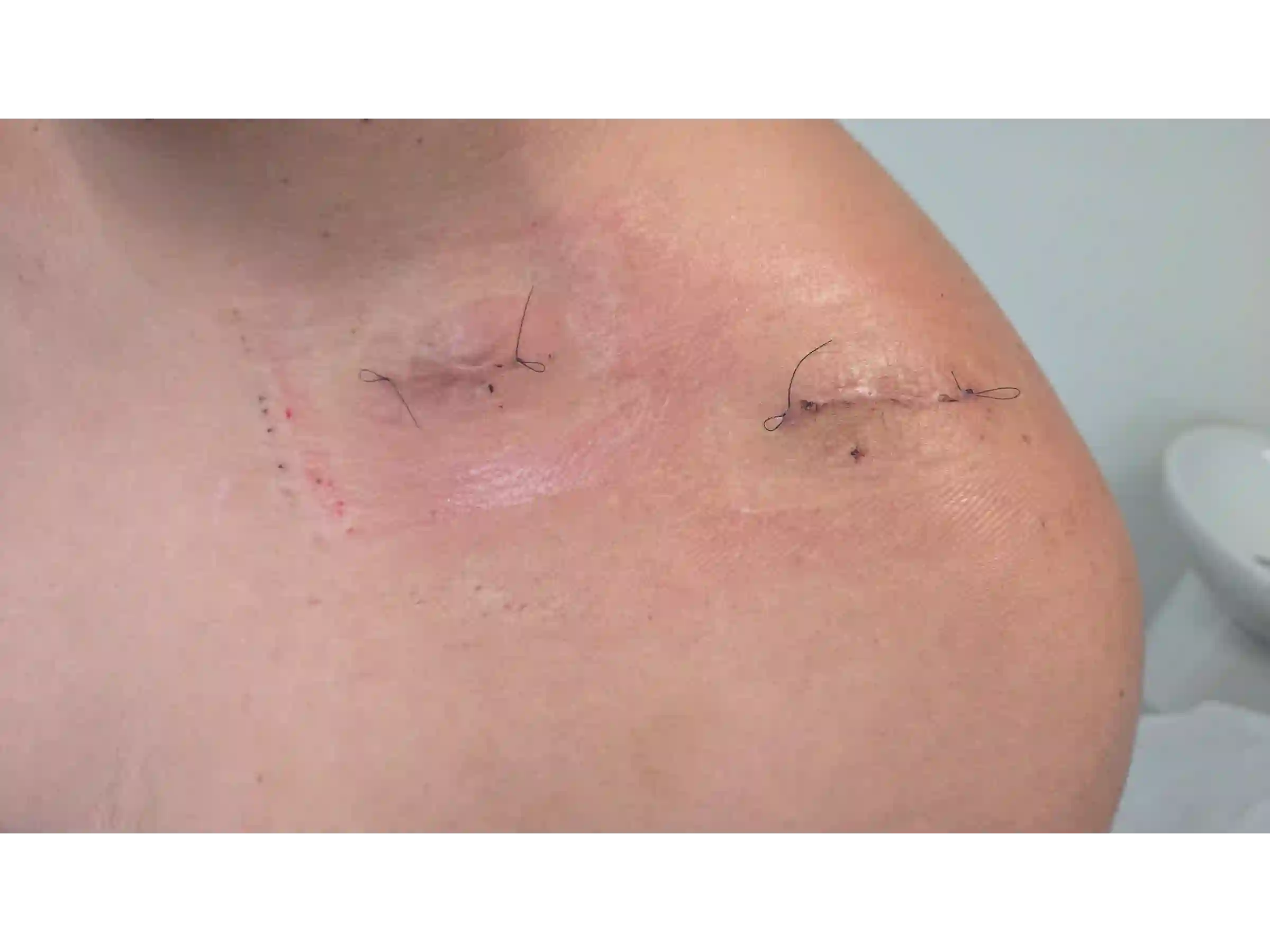 CLAVICLE [CASE 03] - Minimally Invasive Percutaneous Osteosynthesis