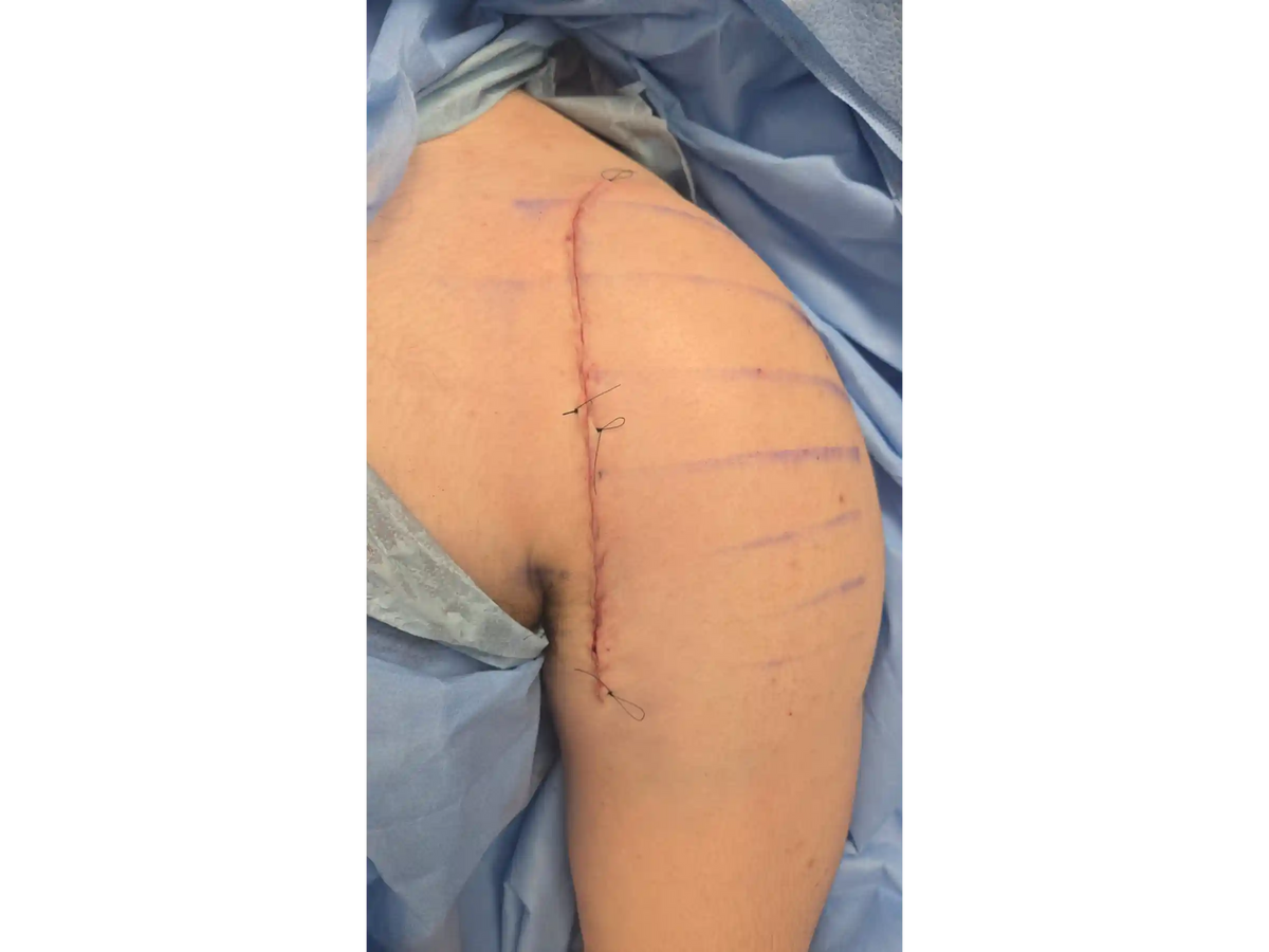 ÚMERO PROXIMAL [CASO 07] - Head-Split Em Paciente Jovem Placa E Parafusos