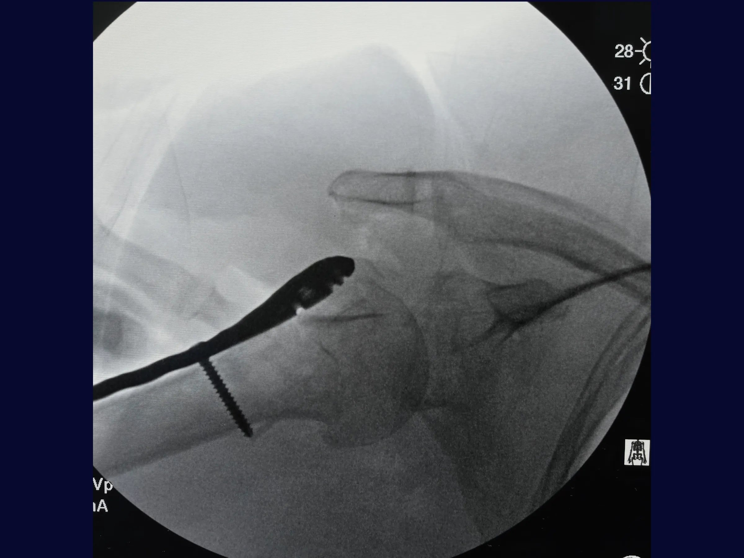 Úmero Proximal – Fratura em 4 Partes
