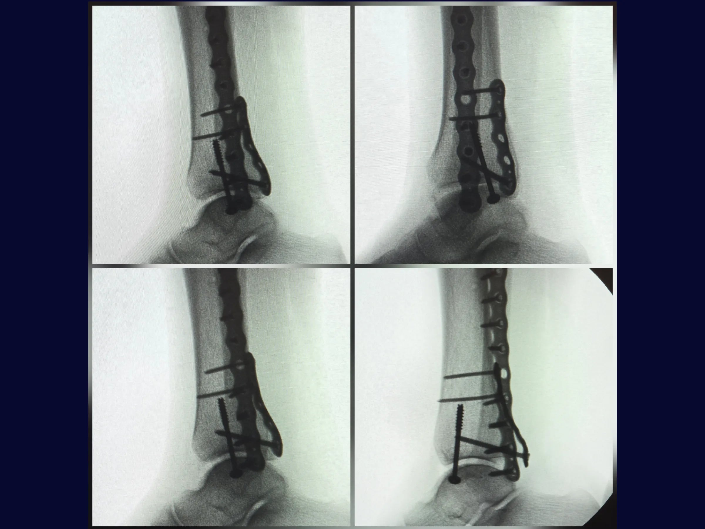 Fratura Trimaleolar - Abordagem em Decúbito Lateral