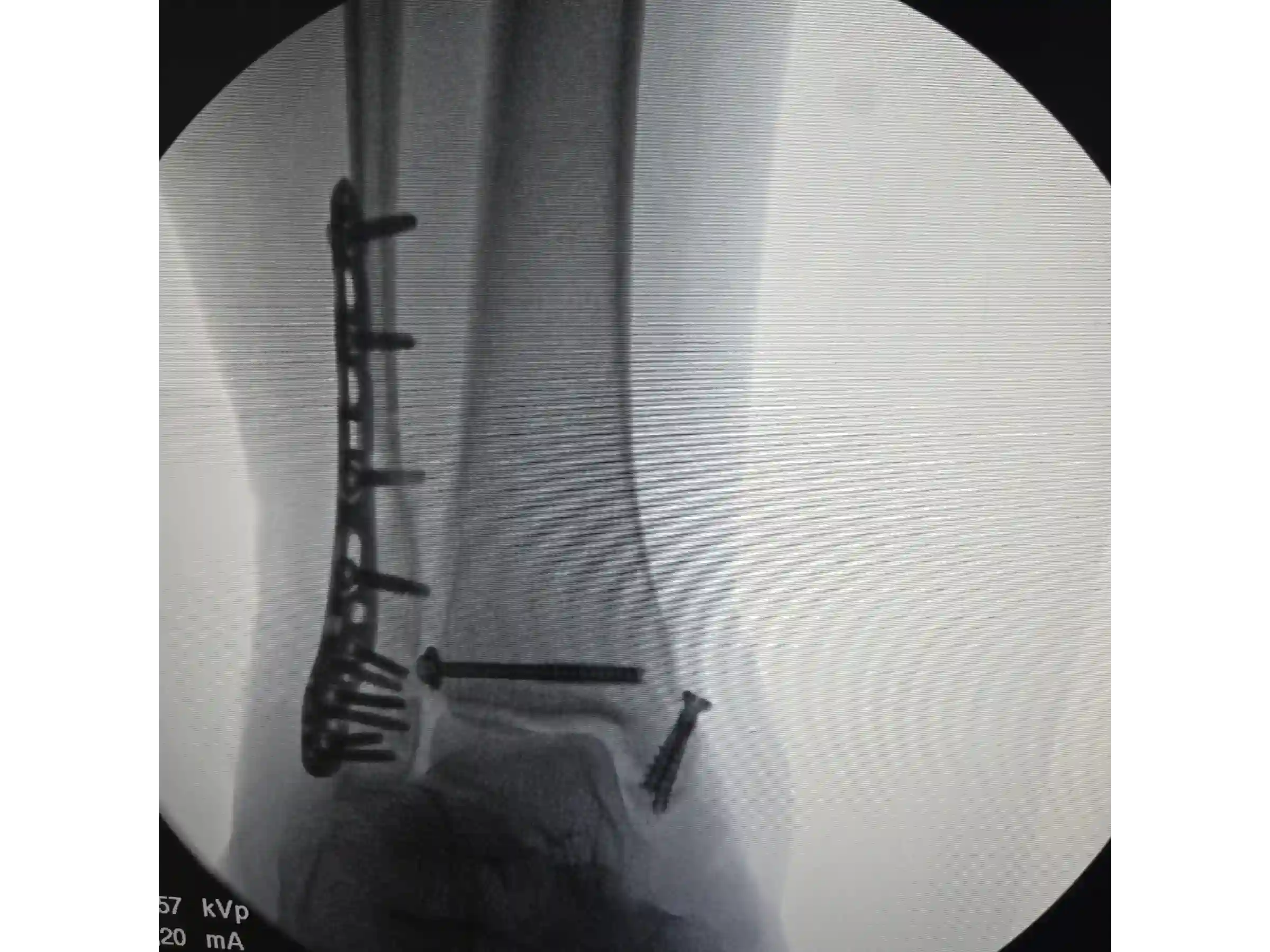 TRIMALEOLAR [CASO 03] Abordagem posterolateral + fixação anterógrada do maléolo medial