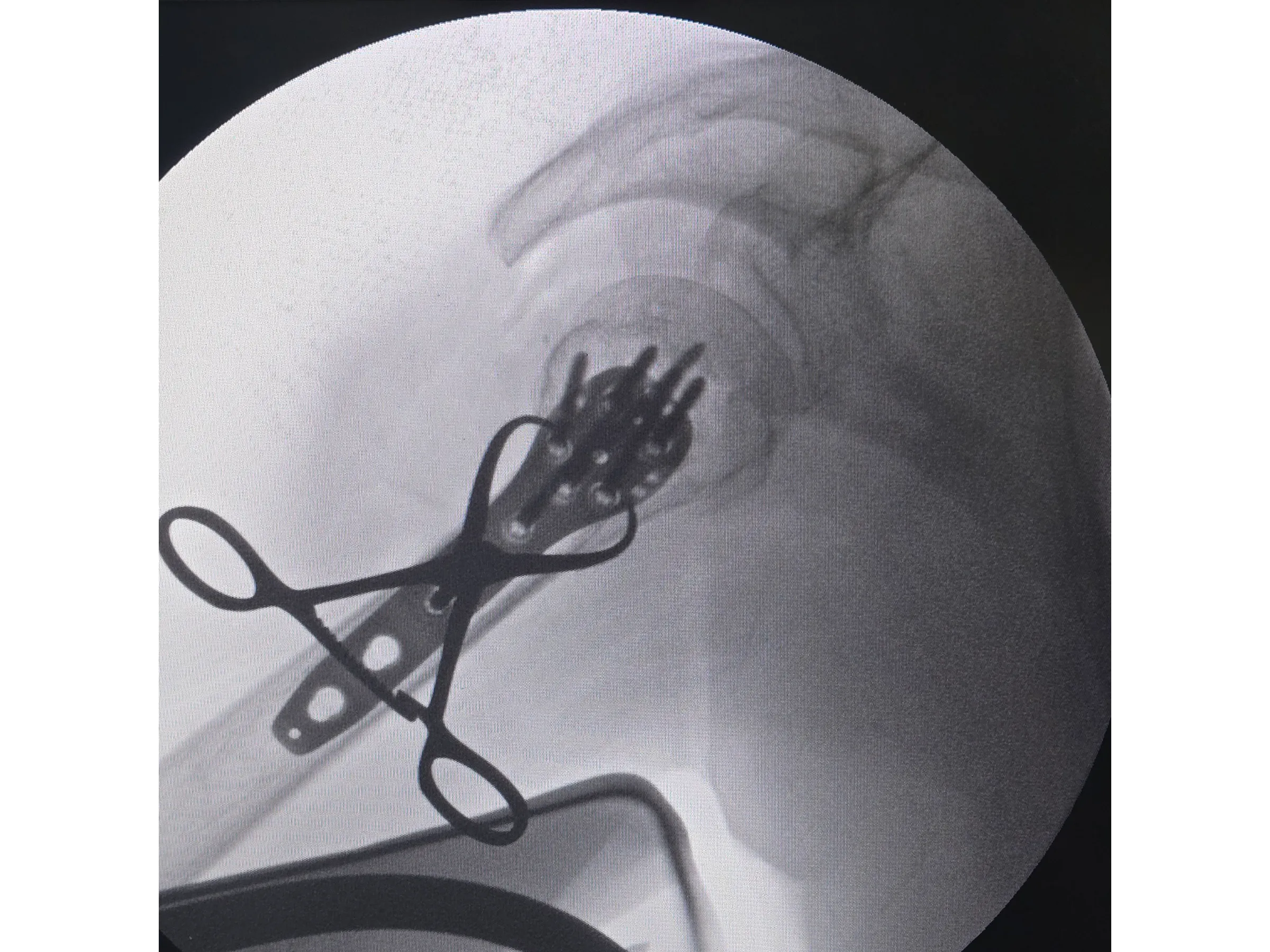 ÚMERO PROXIMAL [Caso 6] · Duas Partes · Placa e Parafusos