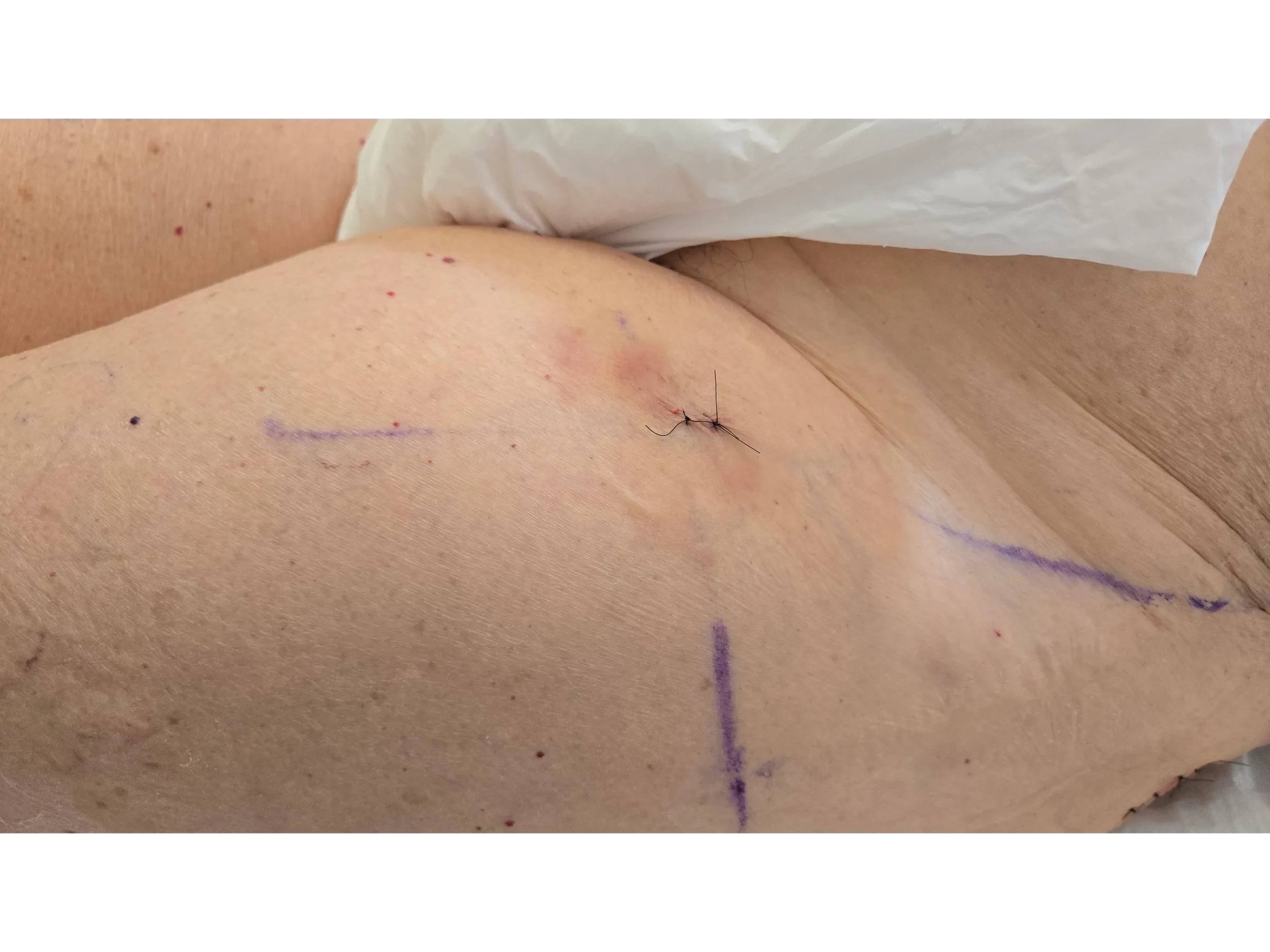 FRATURA SUBTROCANTERIANA [Caso 1] · Haste Intramedular Minimamente Invasiva