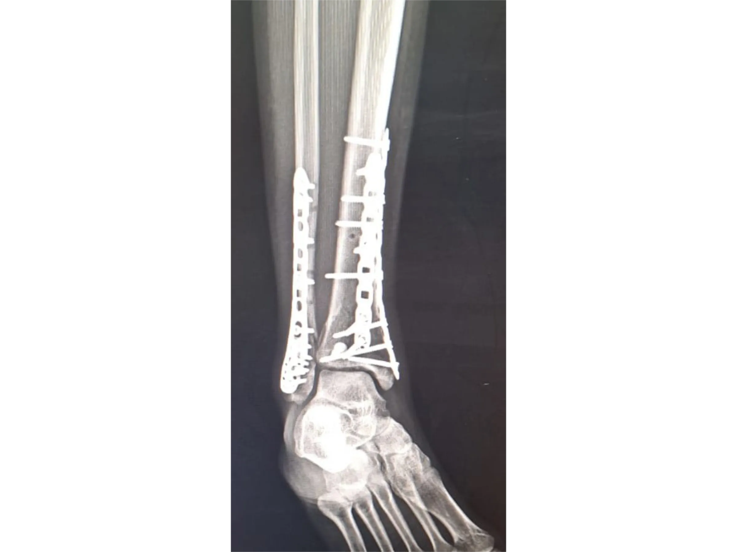 PILÃO TIBIAL [Caso 2] · Abordagem Póstero-Medial + Lateral