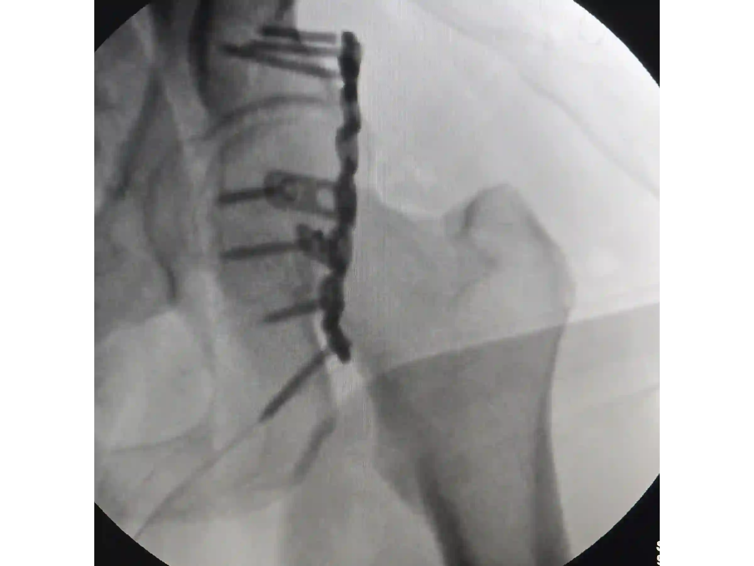 ACETÁBULO [CASO 02] · Rebordo Posterior + Impacção Articular