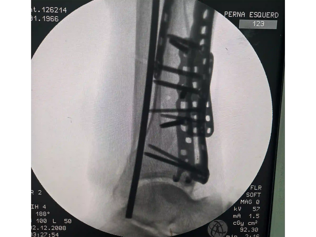PILÃO TIBIAL [CASO 03] Abordagem Anterolateral e Posteromedial