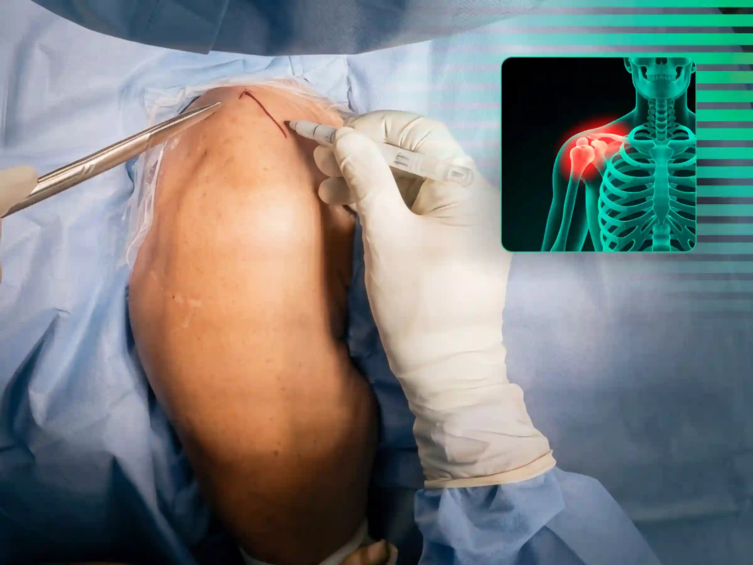 ACROMIOCLAVICULAR [CASO 3] Fixação com TightRope