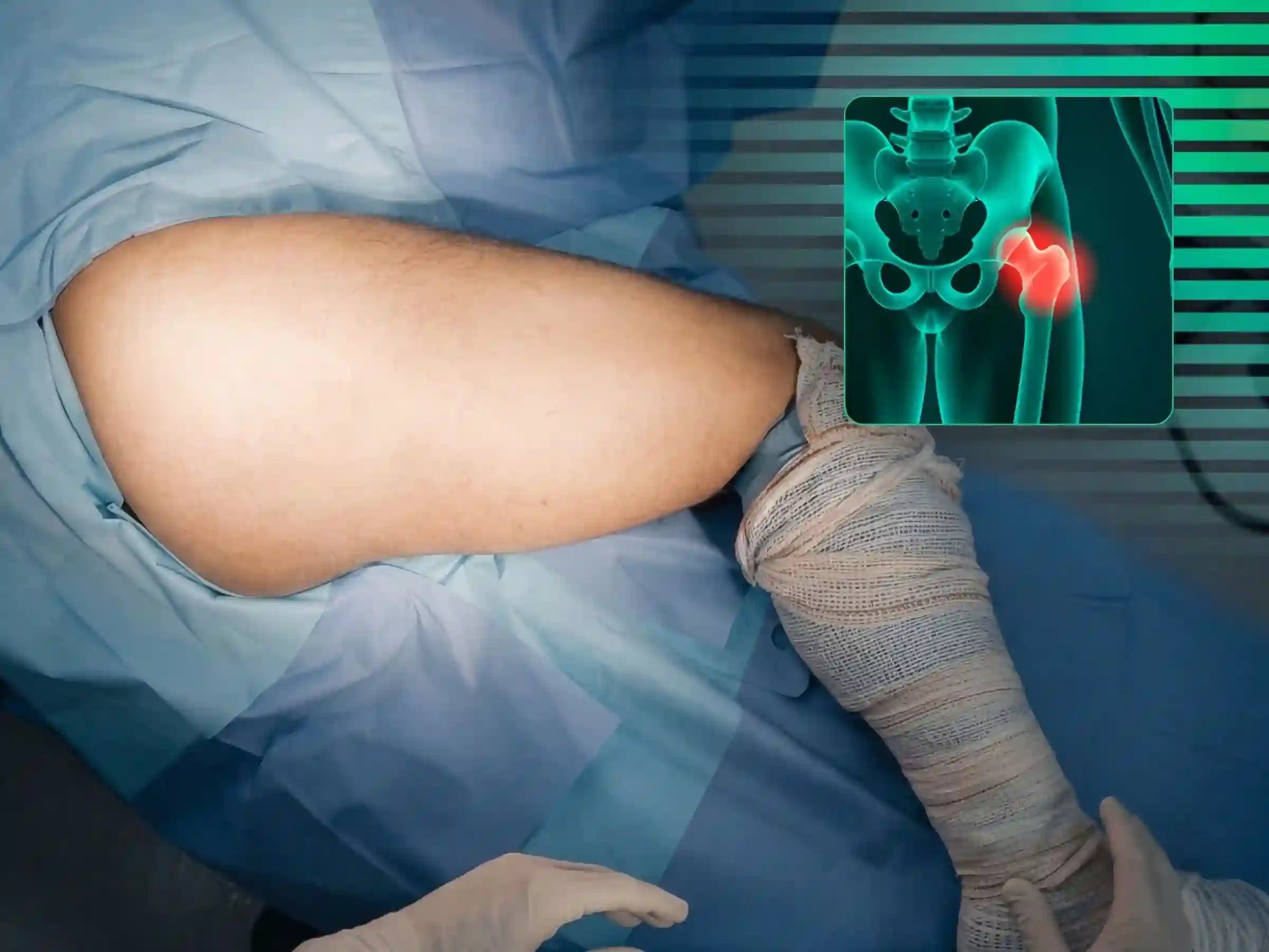 ACETÁBULO [CASO 02] · Rebordo Posterior + Impacção Articular