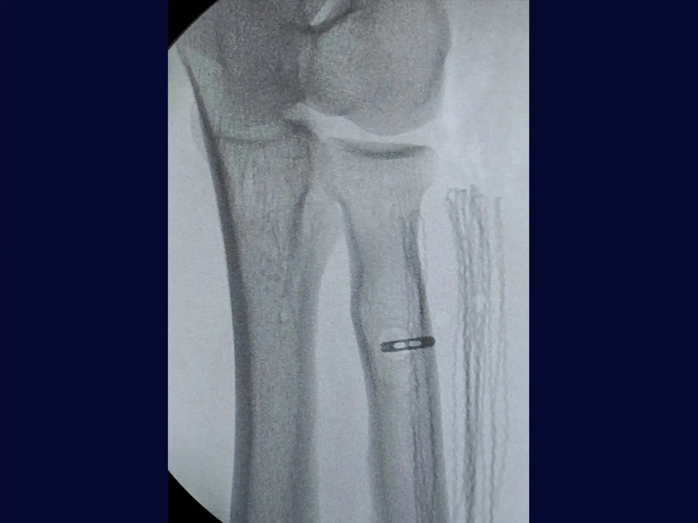 Anatomic Reconstruction of the Distal Biceps Tendon with TightRope
