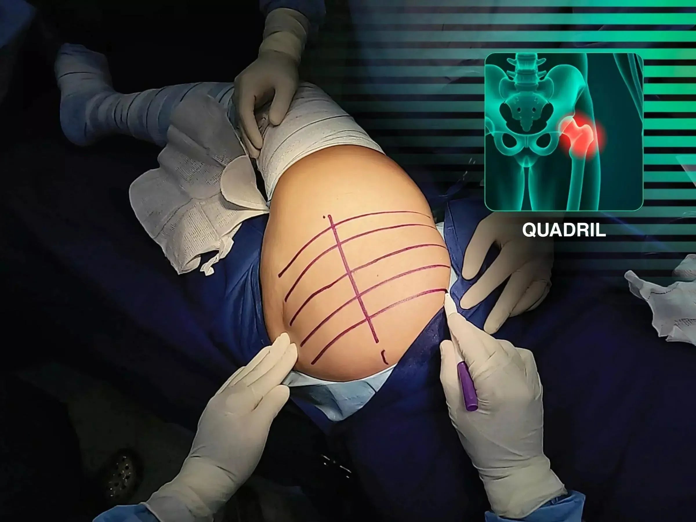 Artroplastia Total do Quadril (ATQ) com Ênfase em Detalhes Técnicos