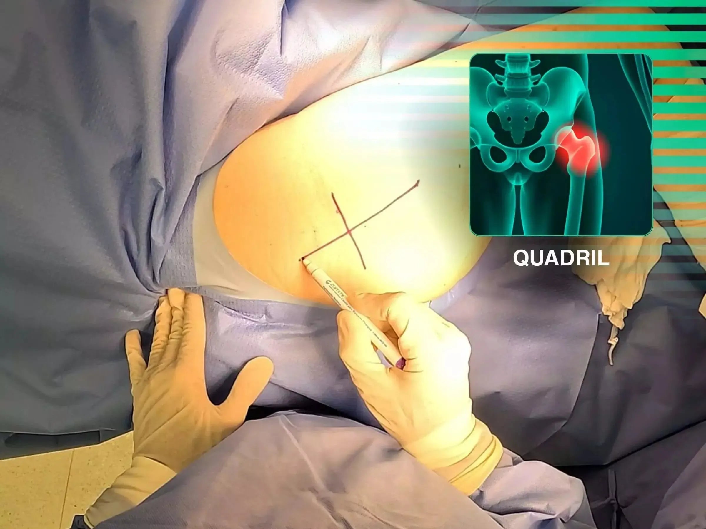 Artroplastia Total do Quadril (ATQ) para Fratura do Colo do Fêmur (Acesso Posterior)