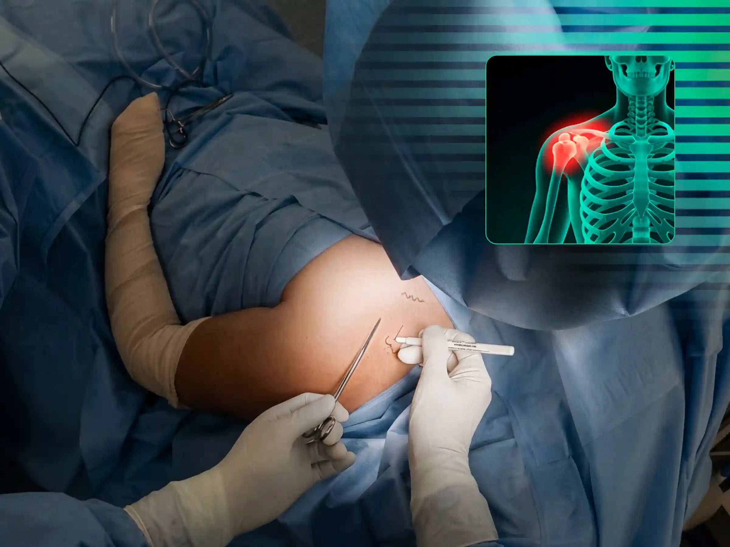 CLAVICLE [CASE 03] - Minimally Invasive Percutaneous Osteosynthesis