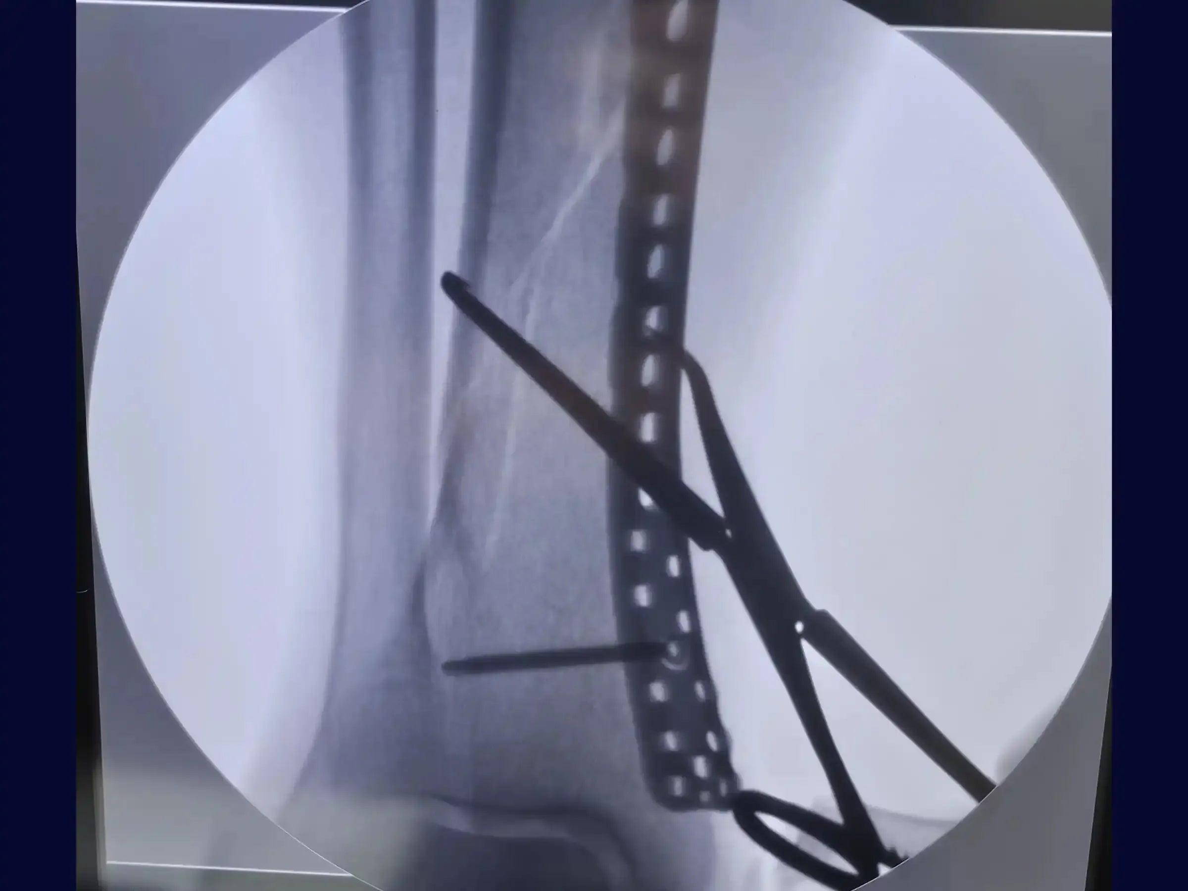 Distal Tibia Fracture - Treatment with Locked Plate