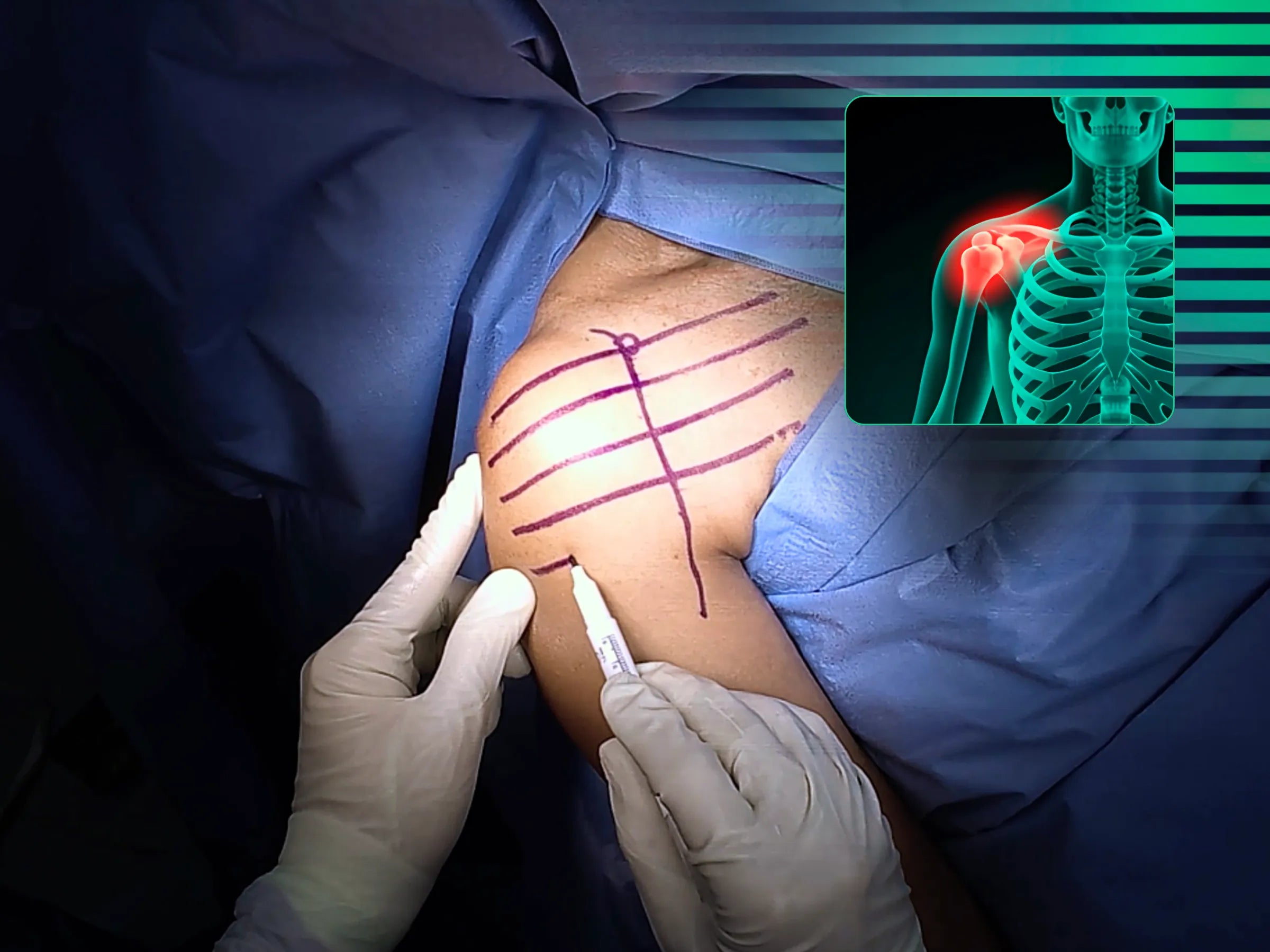 Fratura do Úmero Proximal em 2 Partes (Acesso Deltopeitoral)