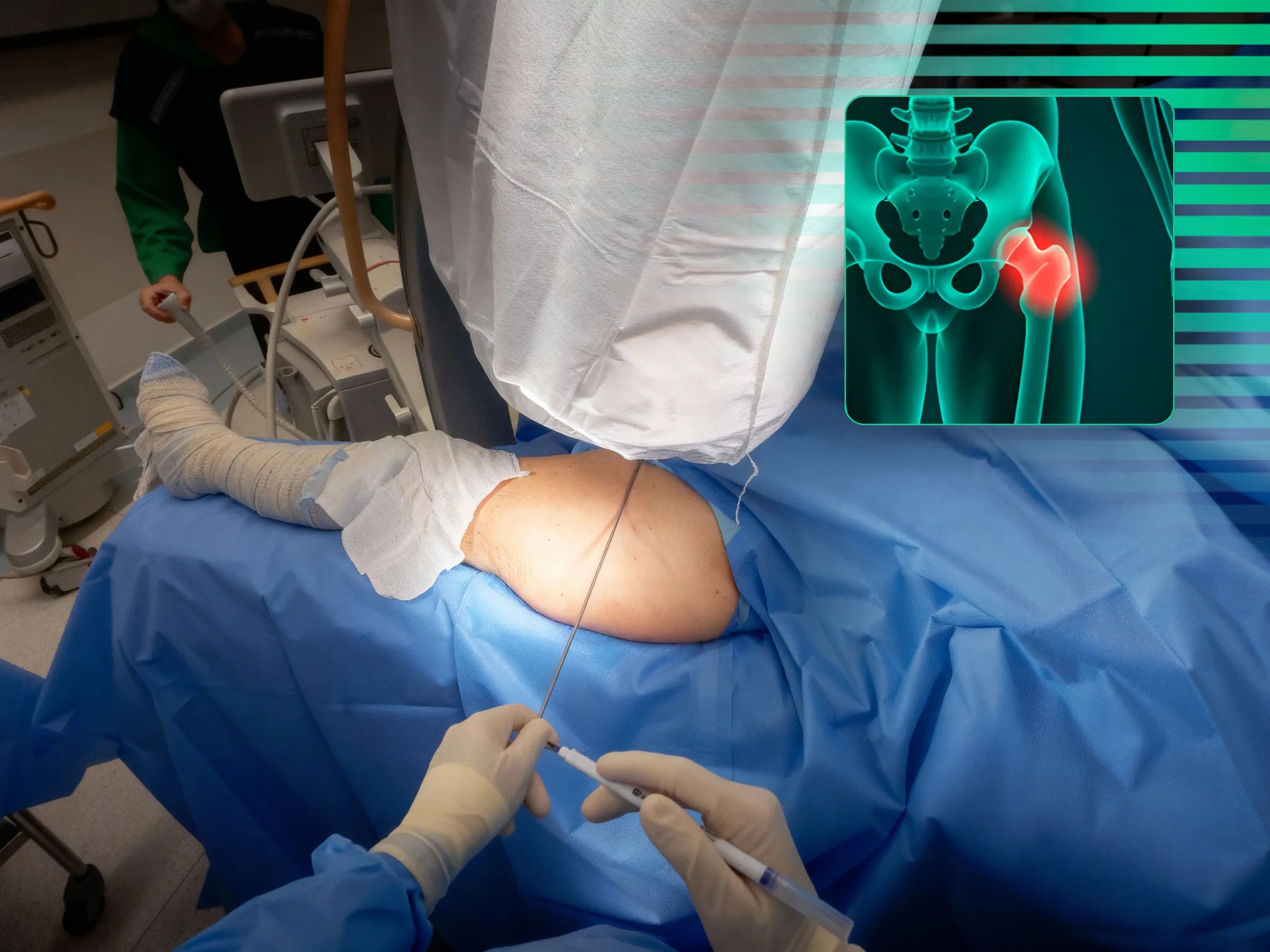 FRATURA SUBTROCANTERIANA [Caso 1] · Haste Intramedular Minimamente Invasiva