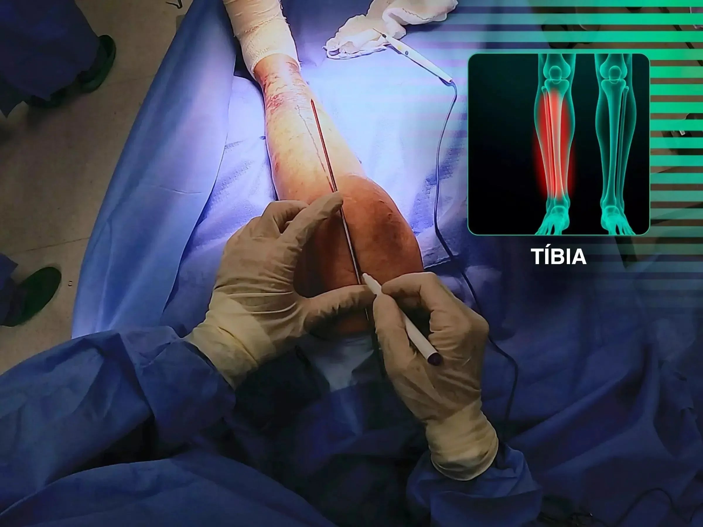 Fratura Diafisária Distal de Tíbia via Haste Intramedular com Acesso Suprapatelar