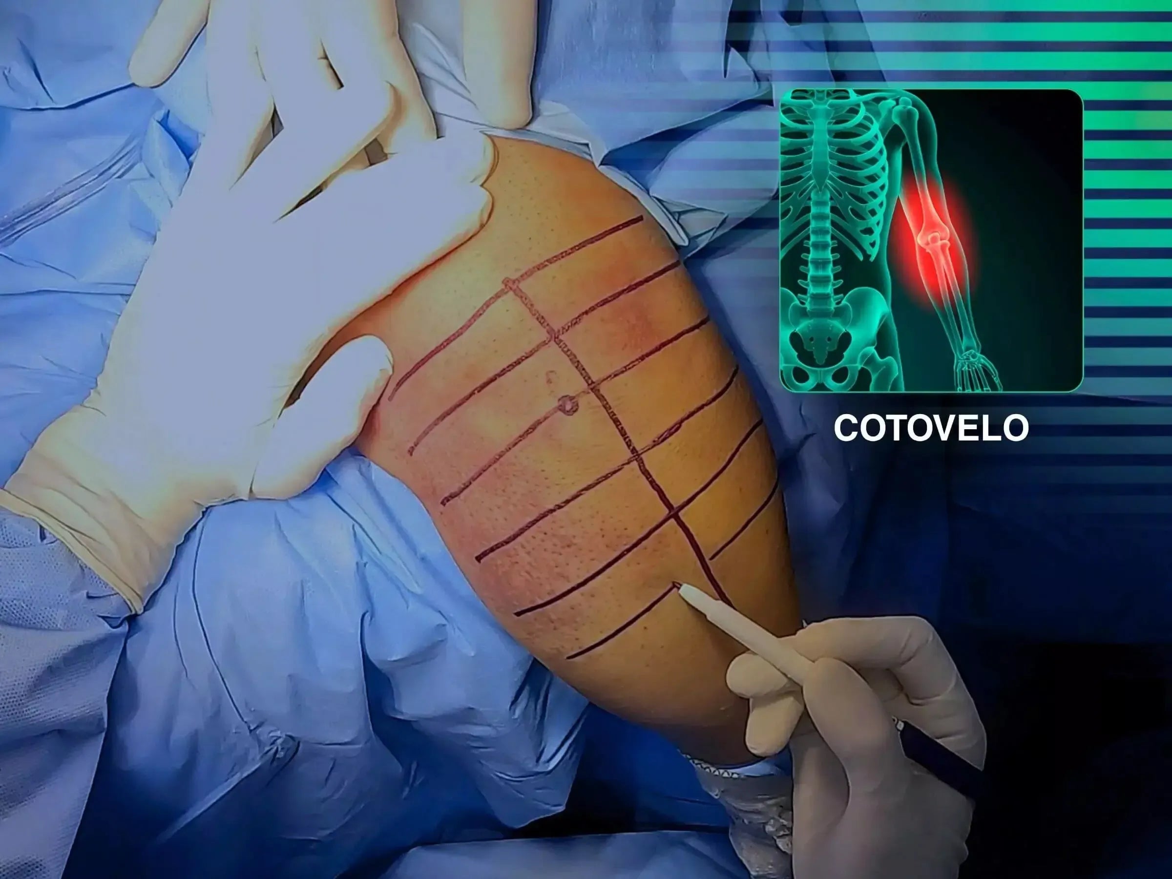 Fratura-Luxação Transolecraniana do Cotovelo (Variante de Monteggia) – Técnica de “Pull-out”