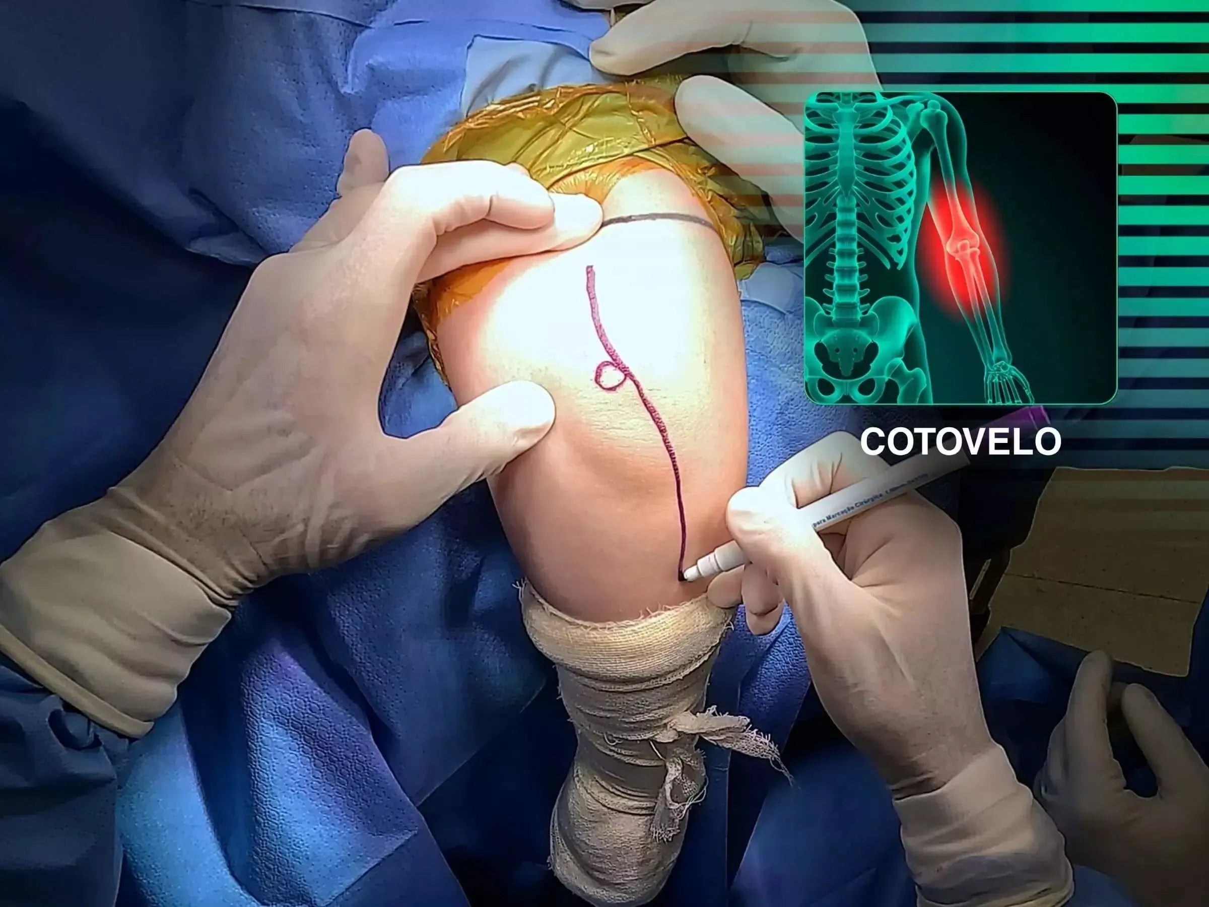 Fratura Metafisária da Ulna Proximal com Luxação e Fratura da Cabeça do Rádio (Variante de Monteggia)