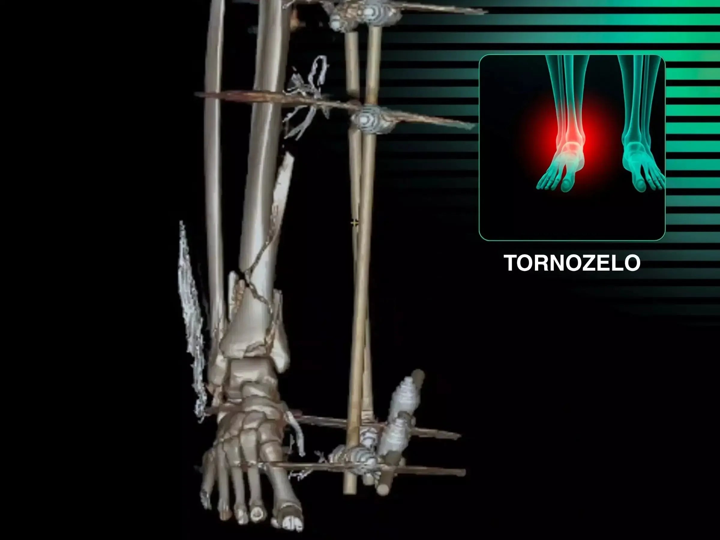 Fratura Multifragmentar do Pilão Tibial (Trauma de Alta Energia)