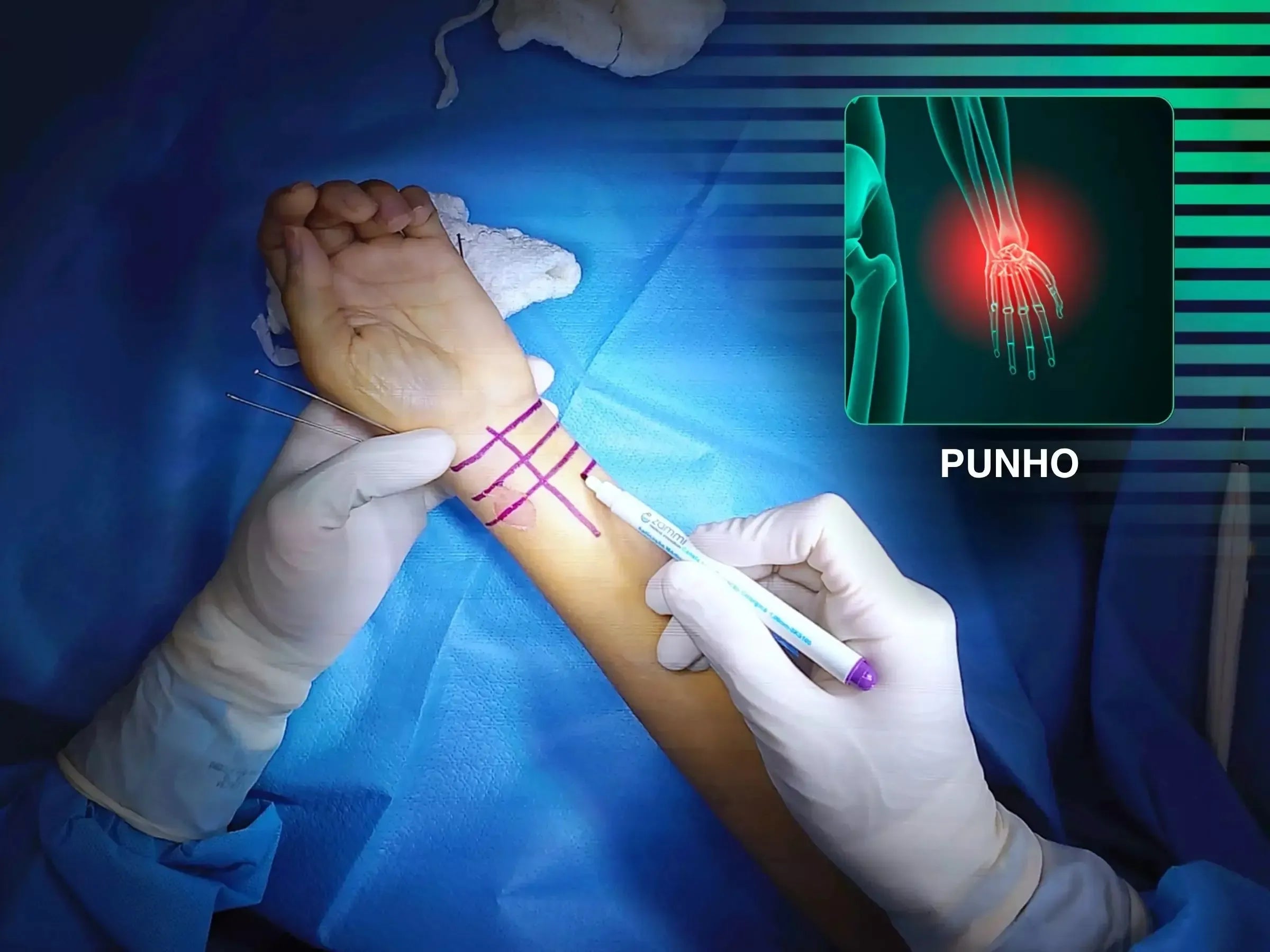 Fratura Multifragmentar do Rádio Distal (Abordagem Volar)