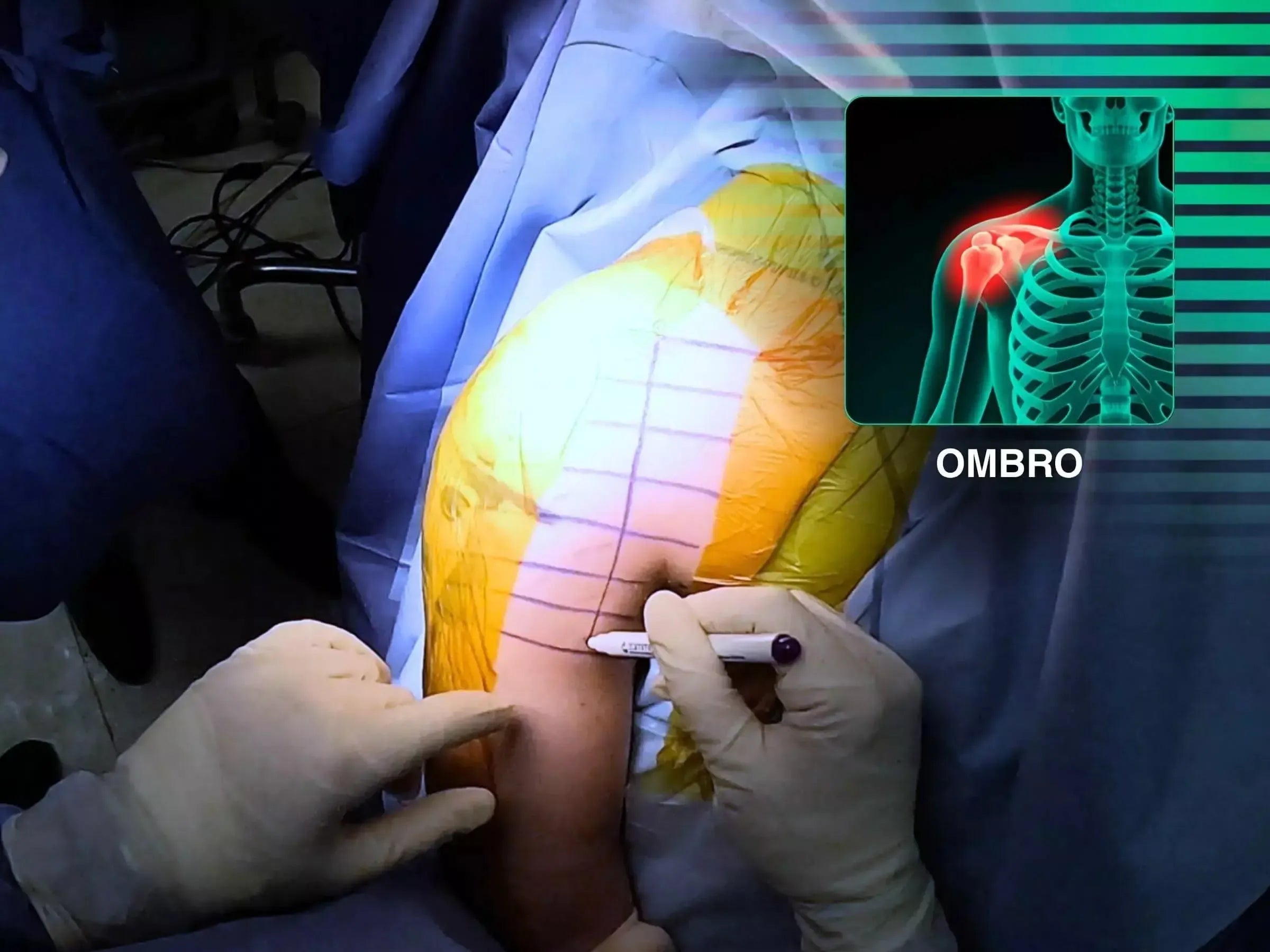 Fratura Segmentar do Úmero Associada a Fraturas da Glenoide e Processo Coracoide