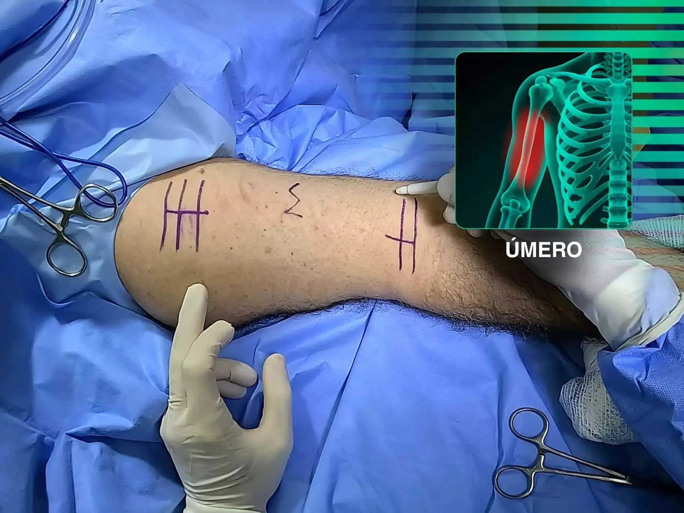 Fratura da Diáfise Umeral - Tratamento com Placa em Ponte