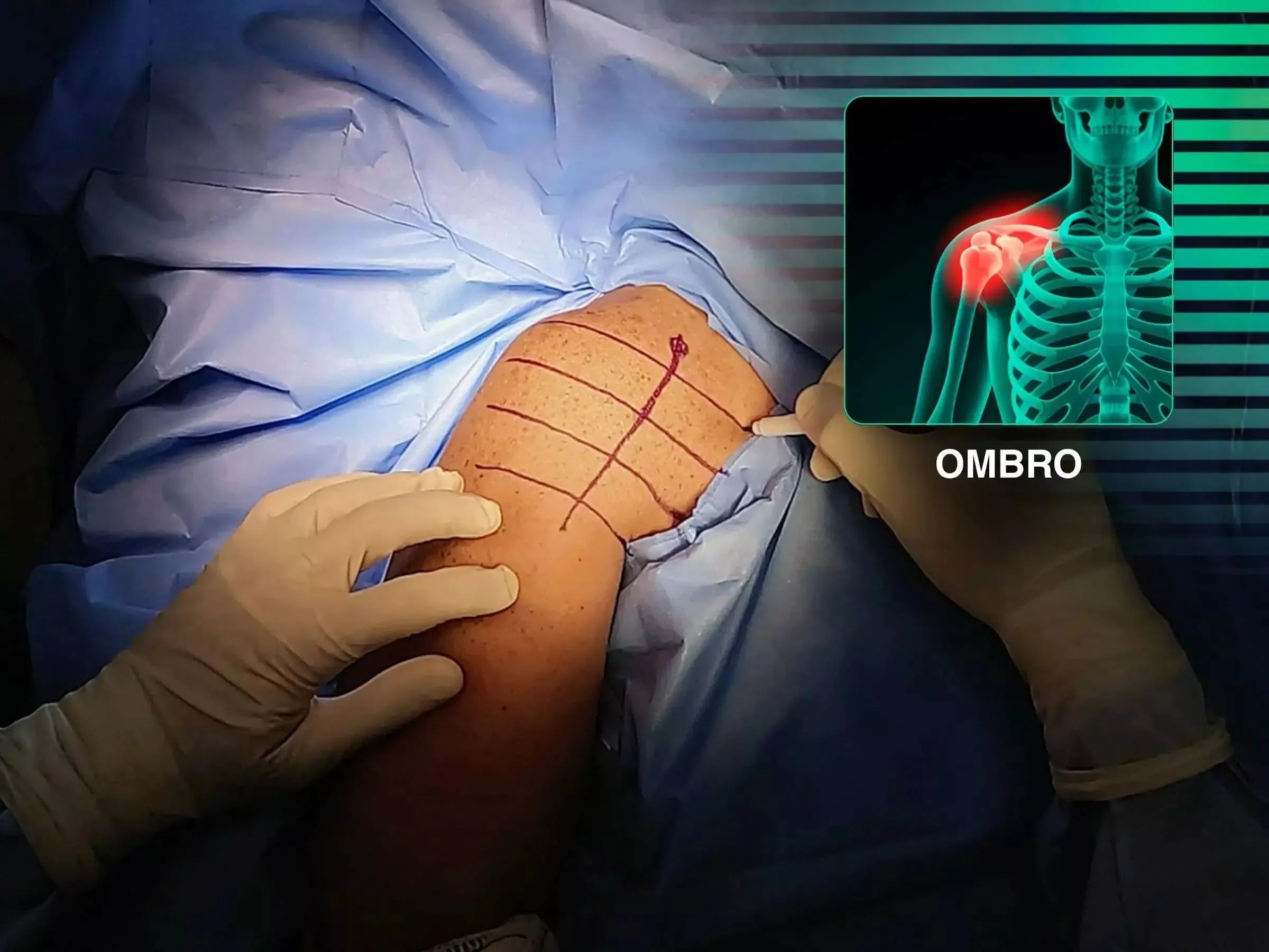 Fratura da Grande Tuberosidade do Úmero com Acesso Deltopeitoral