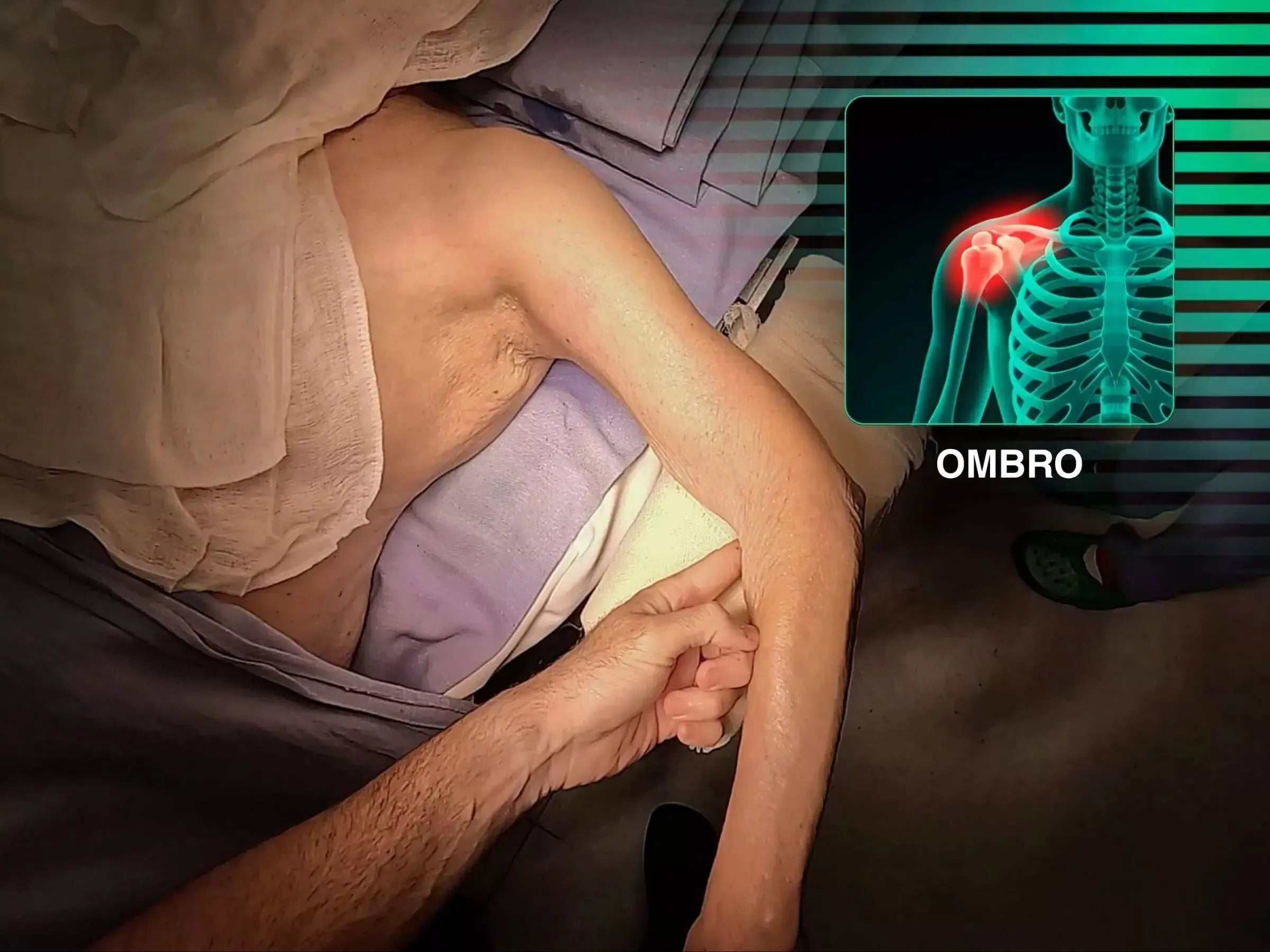 Fratura do Úmero Proximal com Placa (Acesso Deltopeitoral)