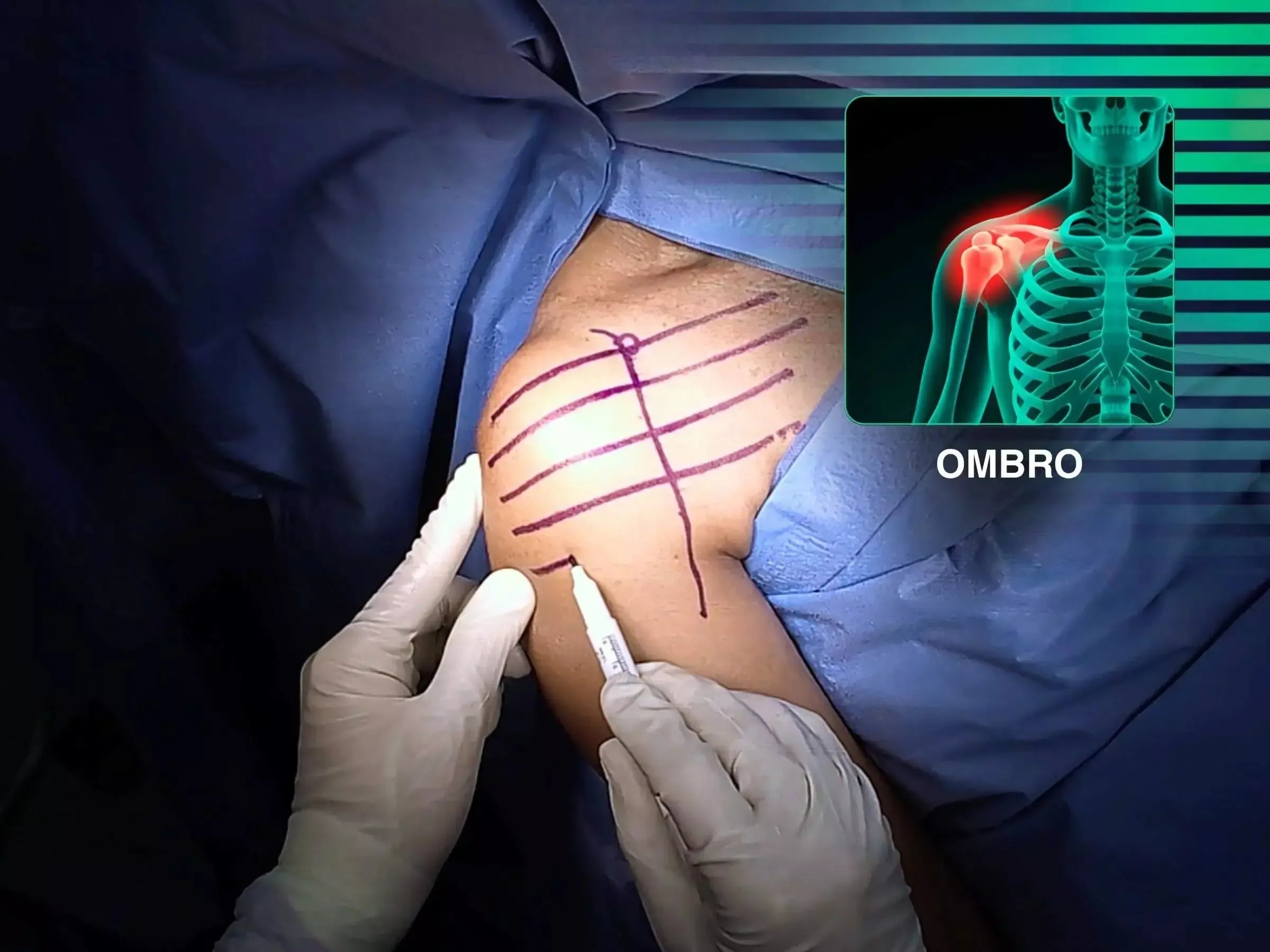 Fratura do Úmero Proximal em 2 Partes (Acesso Deltopeitoral)